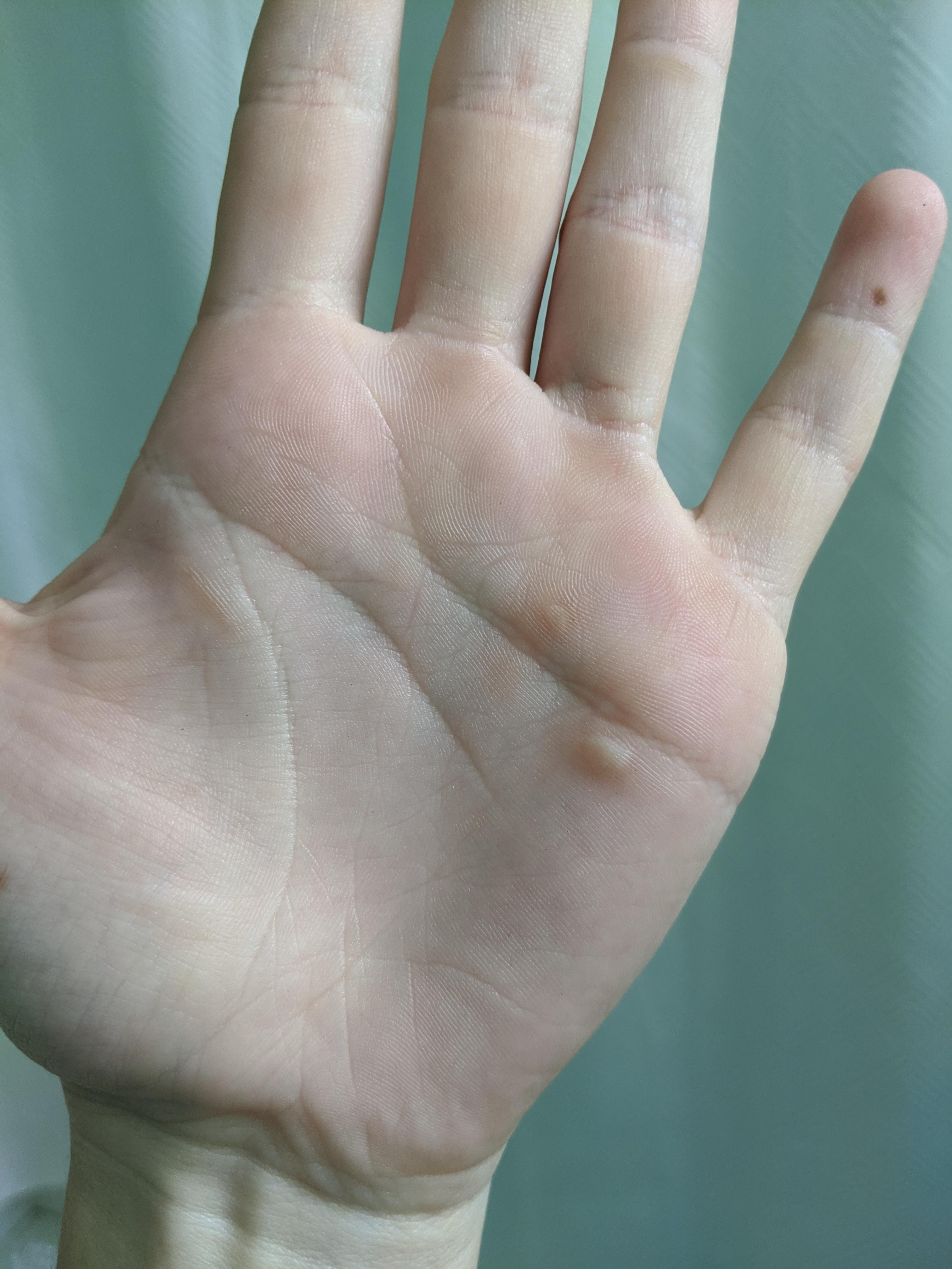 I'm a rower and constantly have these on my hands. The urge to pop is so real. r/popping