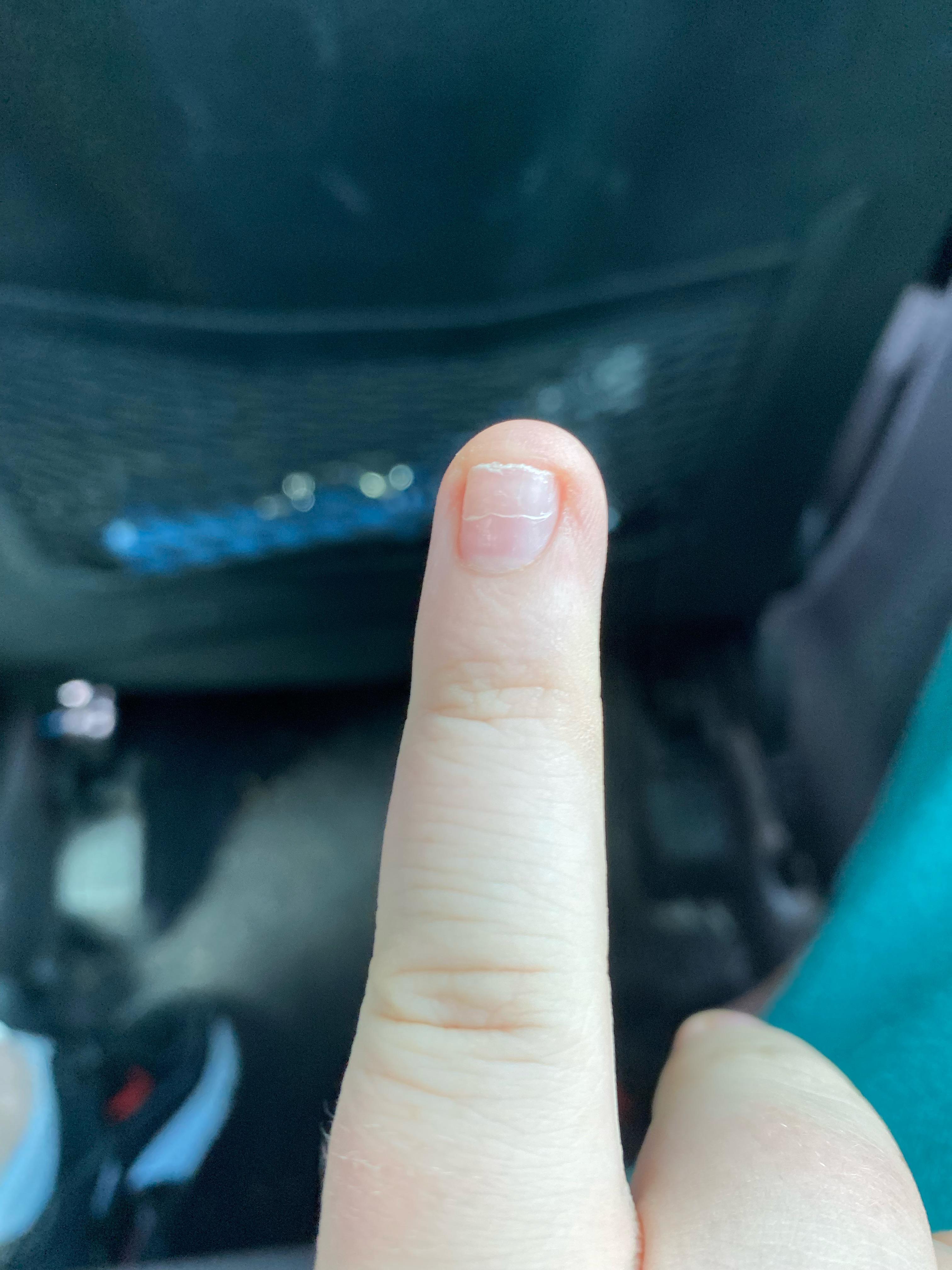 Does anyone know why my fingernail has gone weird r/DiagnoseMe