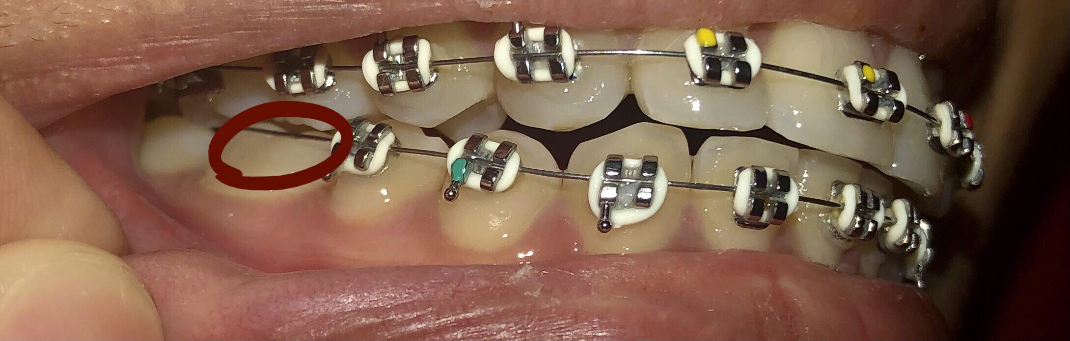 Since I got braces about 3 weeks ago, one of my molar brackets have