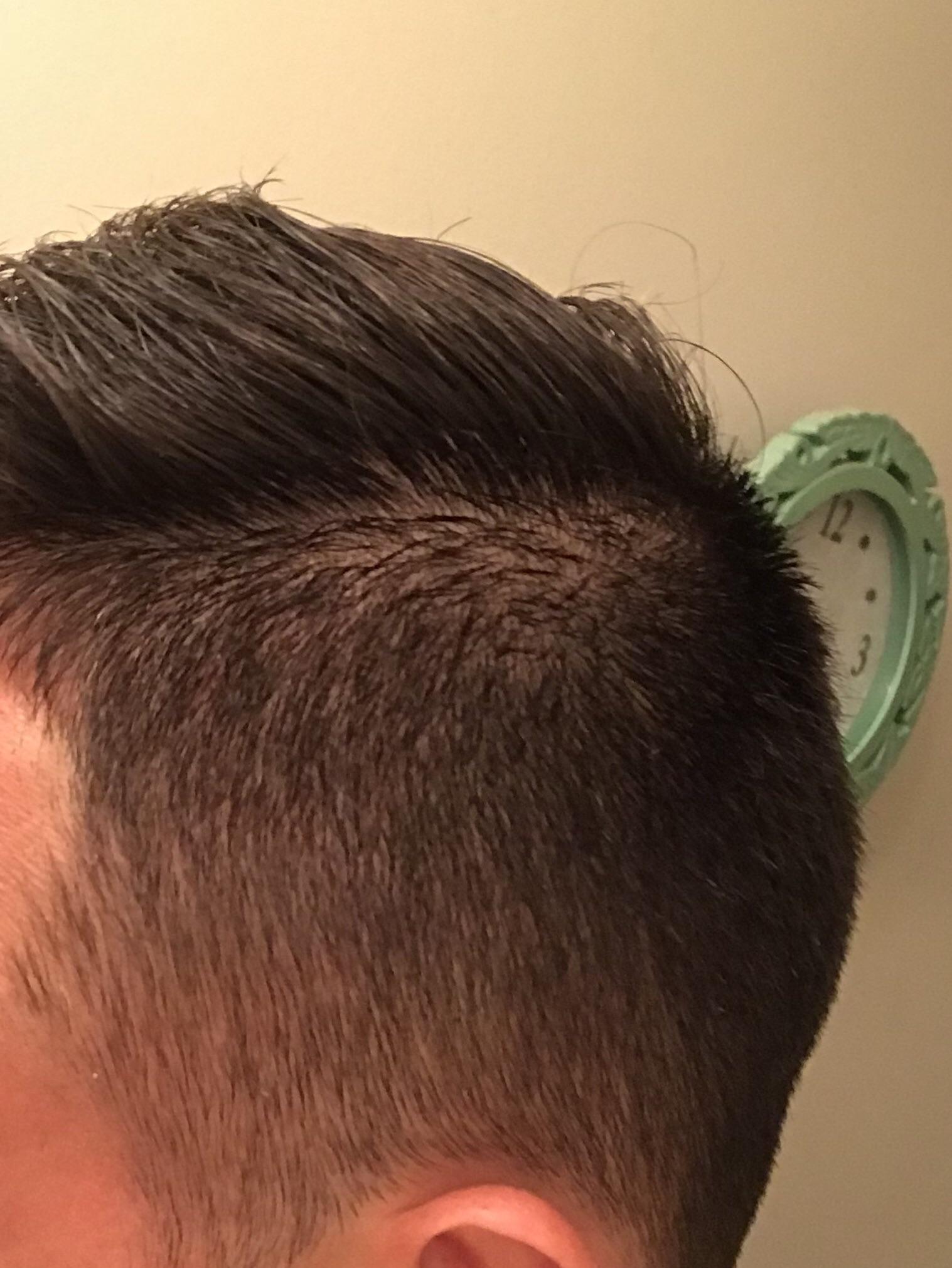 Does this look like moth eaten hair caused by syphilis? r/STD