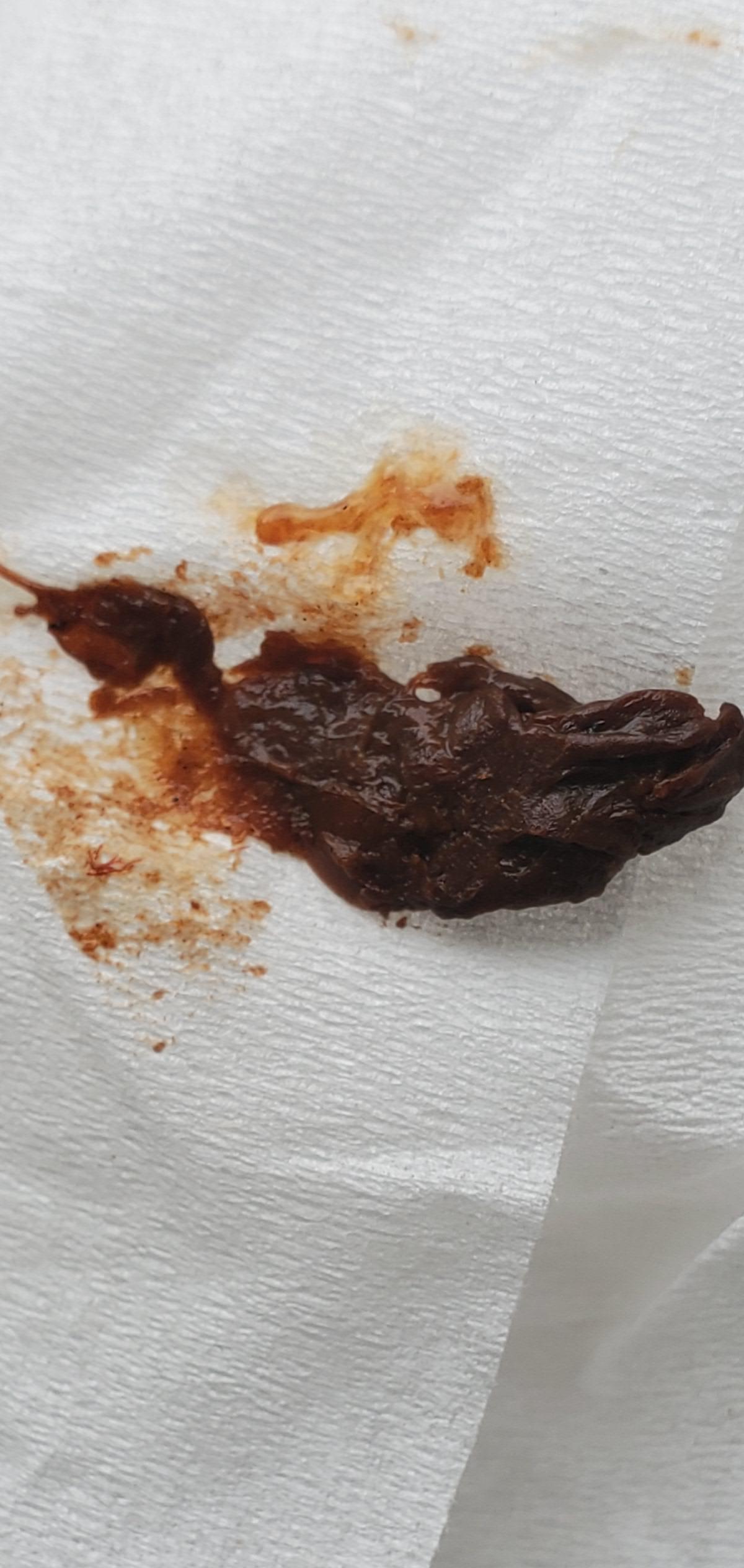 Blood In Human Stool Looks Like