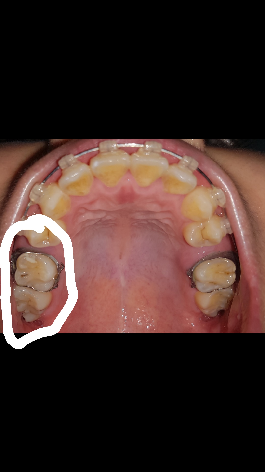 Teeth with molar bands are moving, creating a gap r/braces