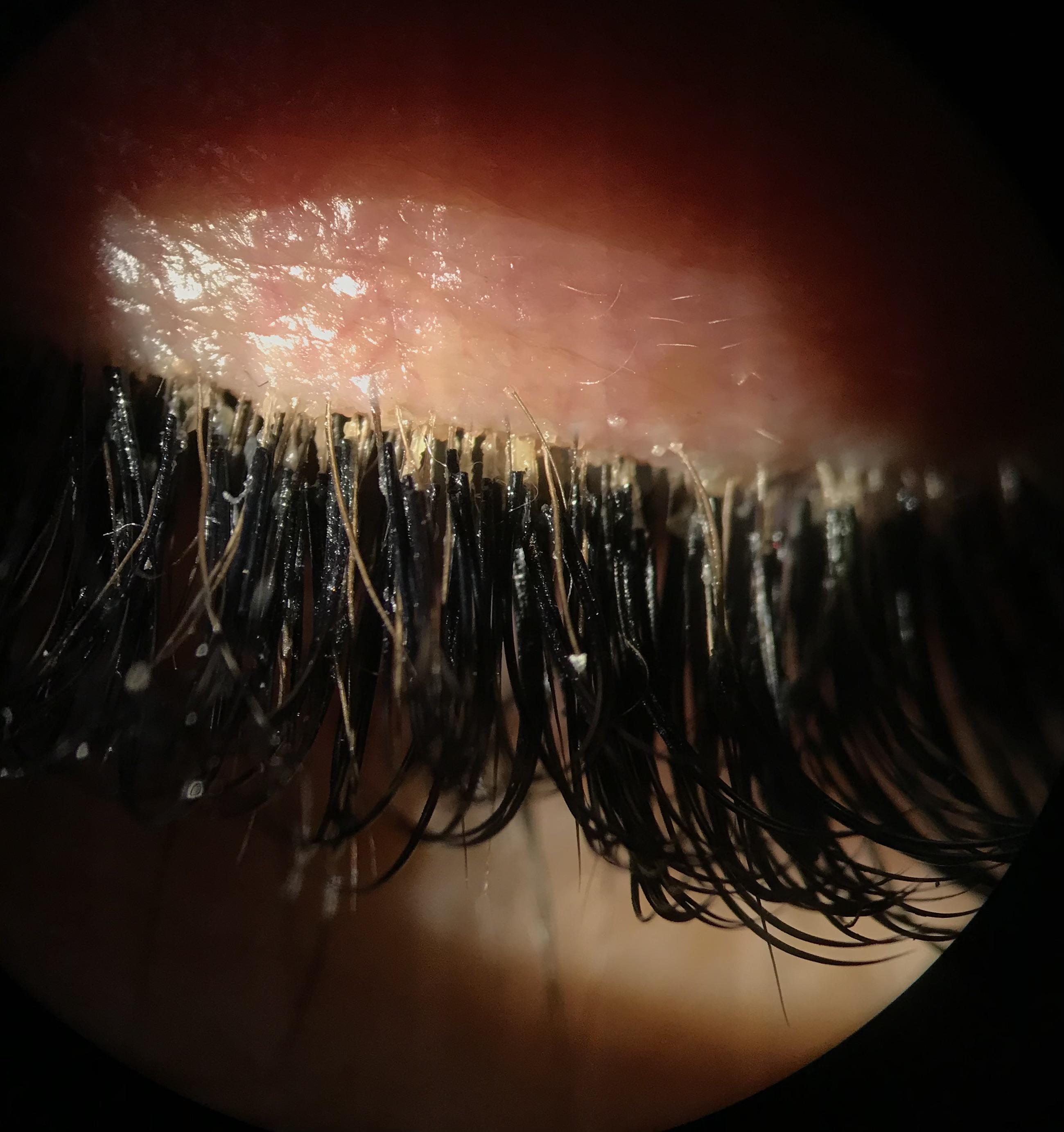 Eyelash extensions and blepharitis r/optometry