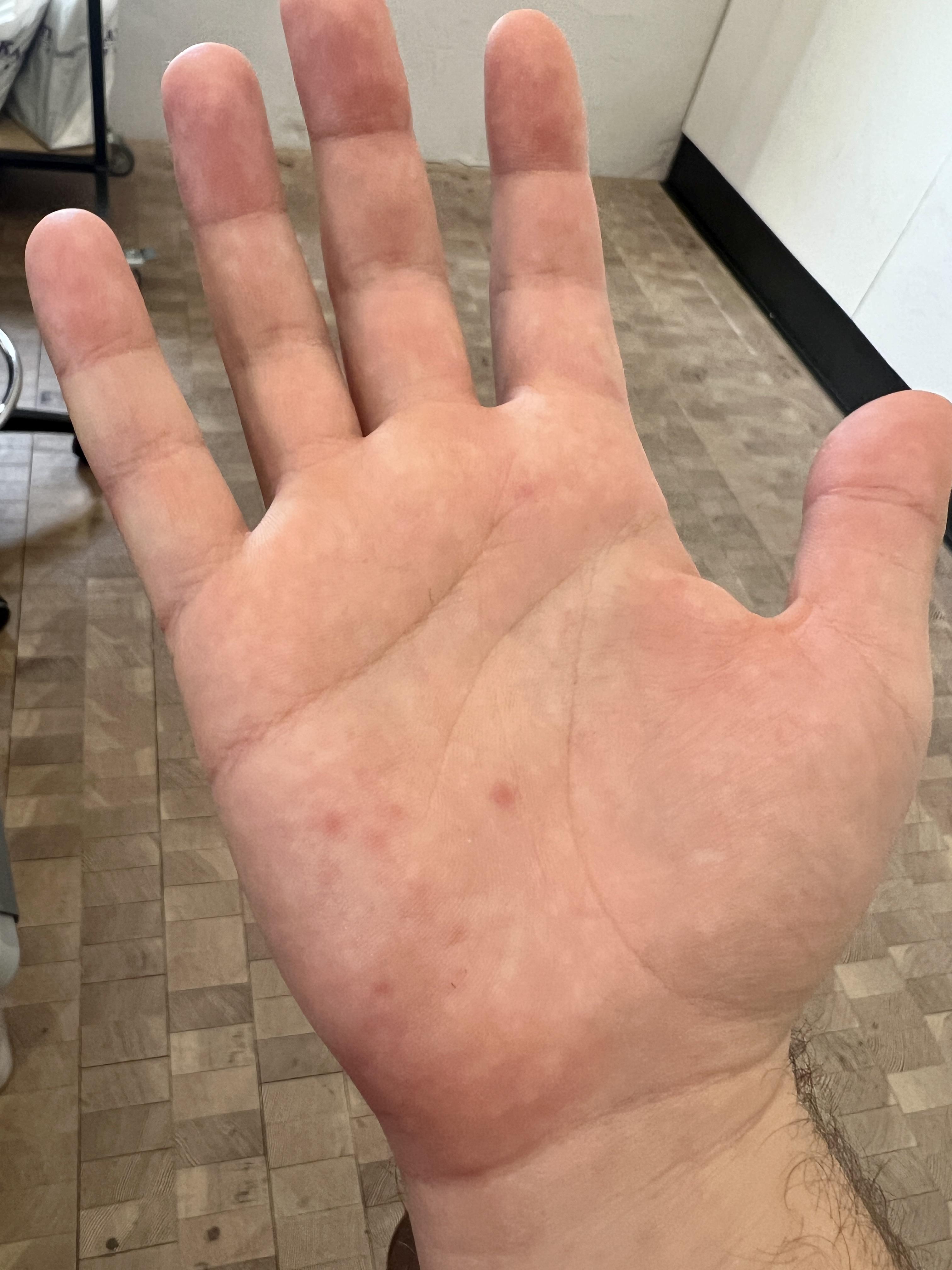 Anybody have any lightweight, warm glove Chilblains