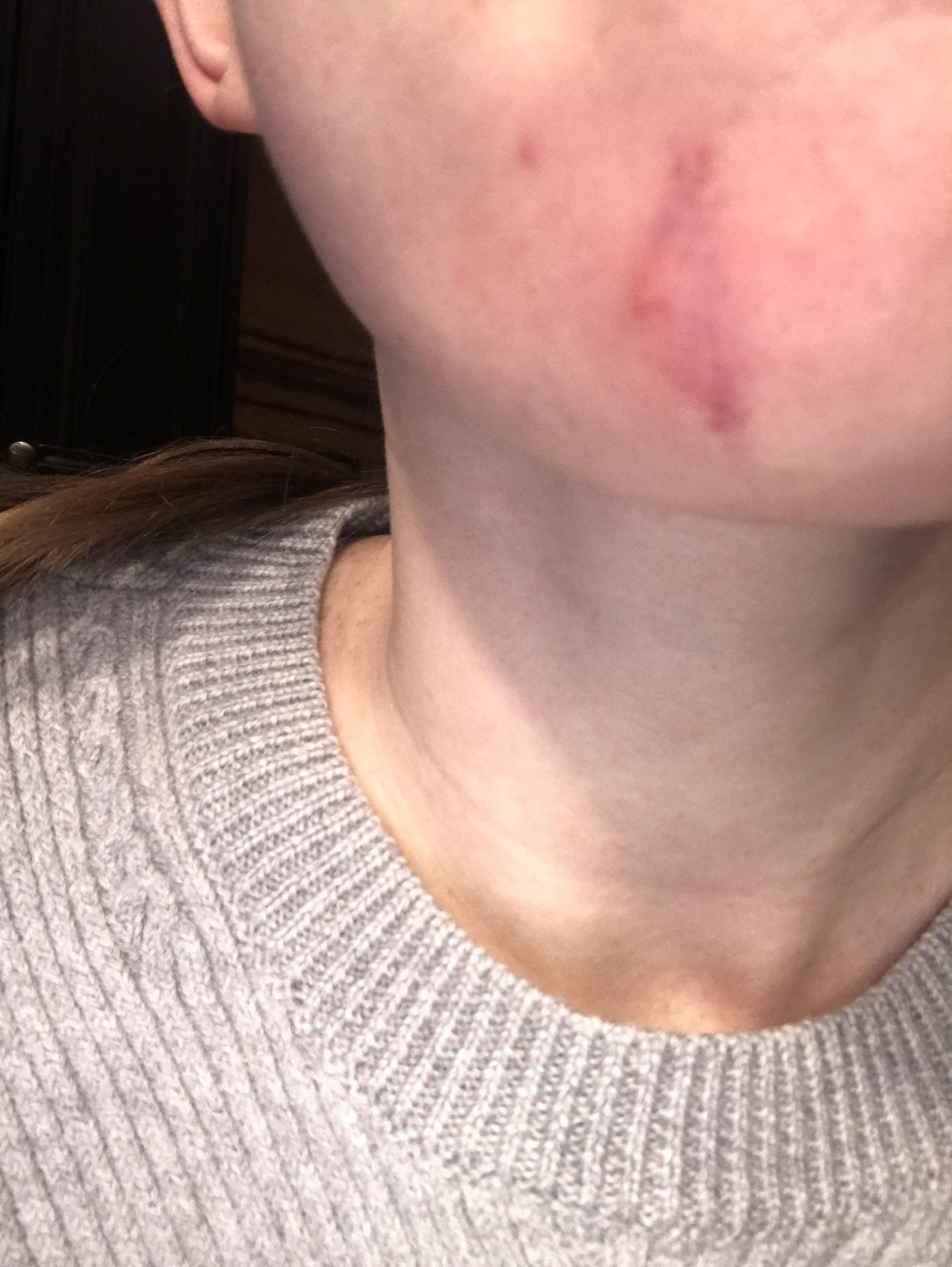 [skin concern] I was messing around with a zit and somehow bruised my