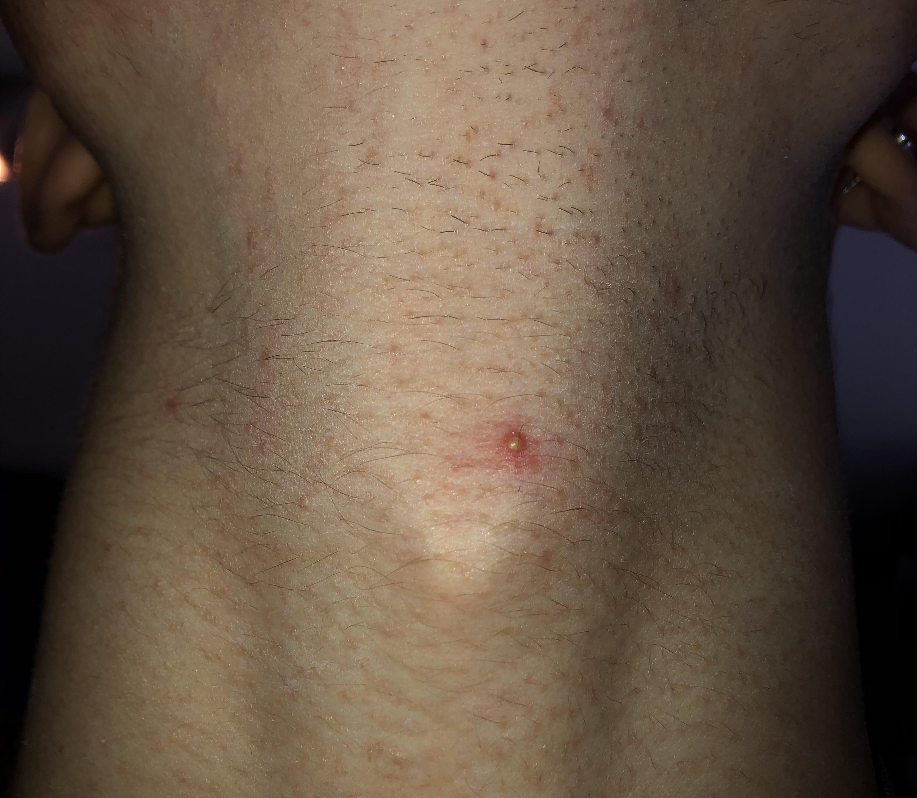 Everytime I shave my neck I get these pimples/bumps. I shave after