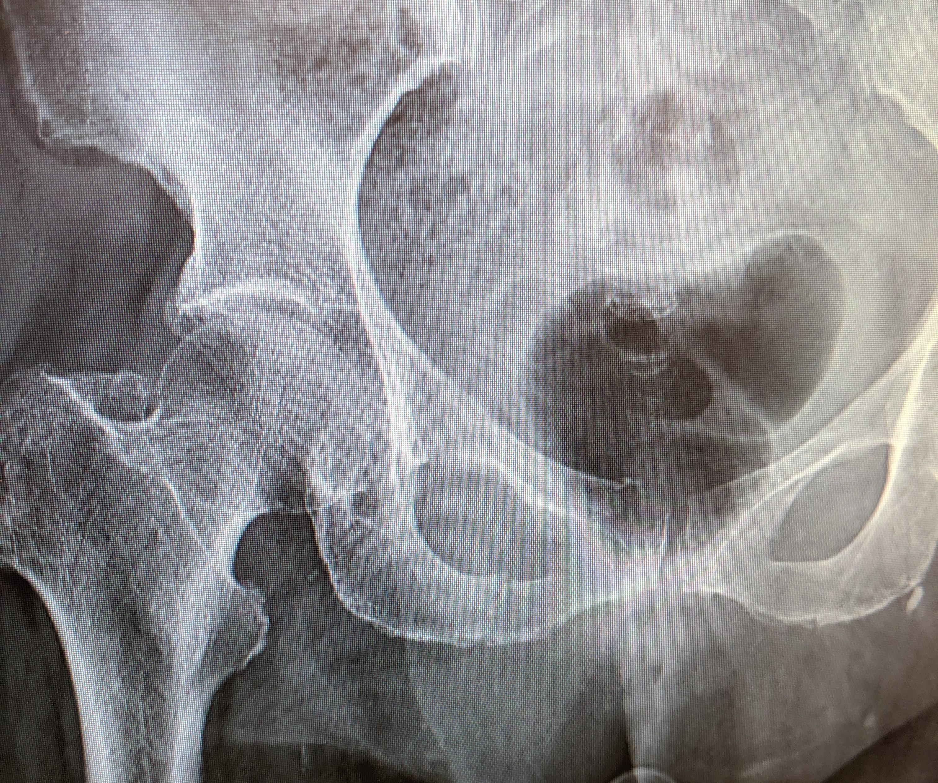 Saw this pubic ramus fracture at my internship. Is there