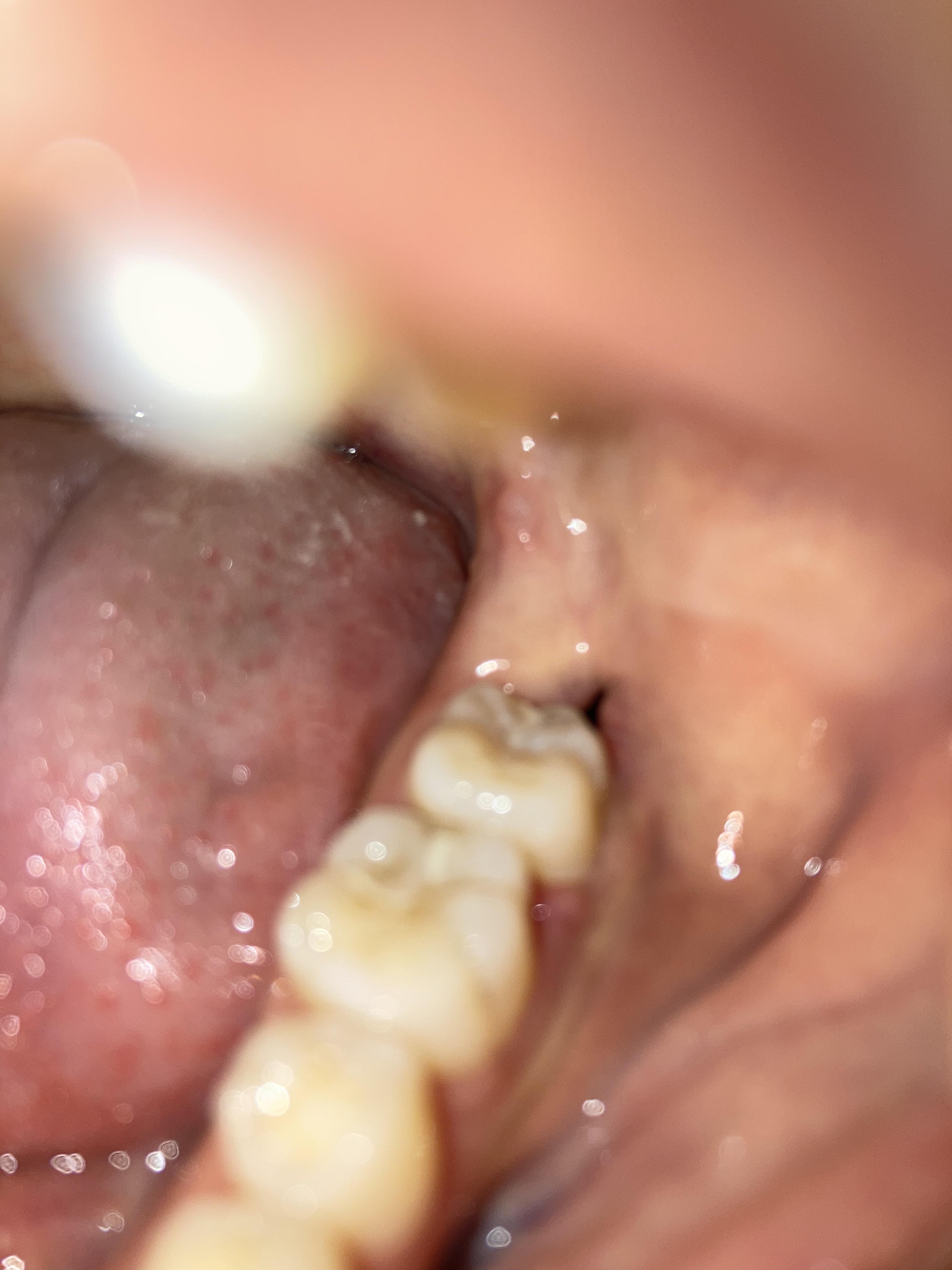I had all 4 of my impacted teeth removed 9 days ago. The dissolvable stitches on my lower left
