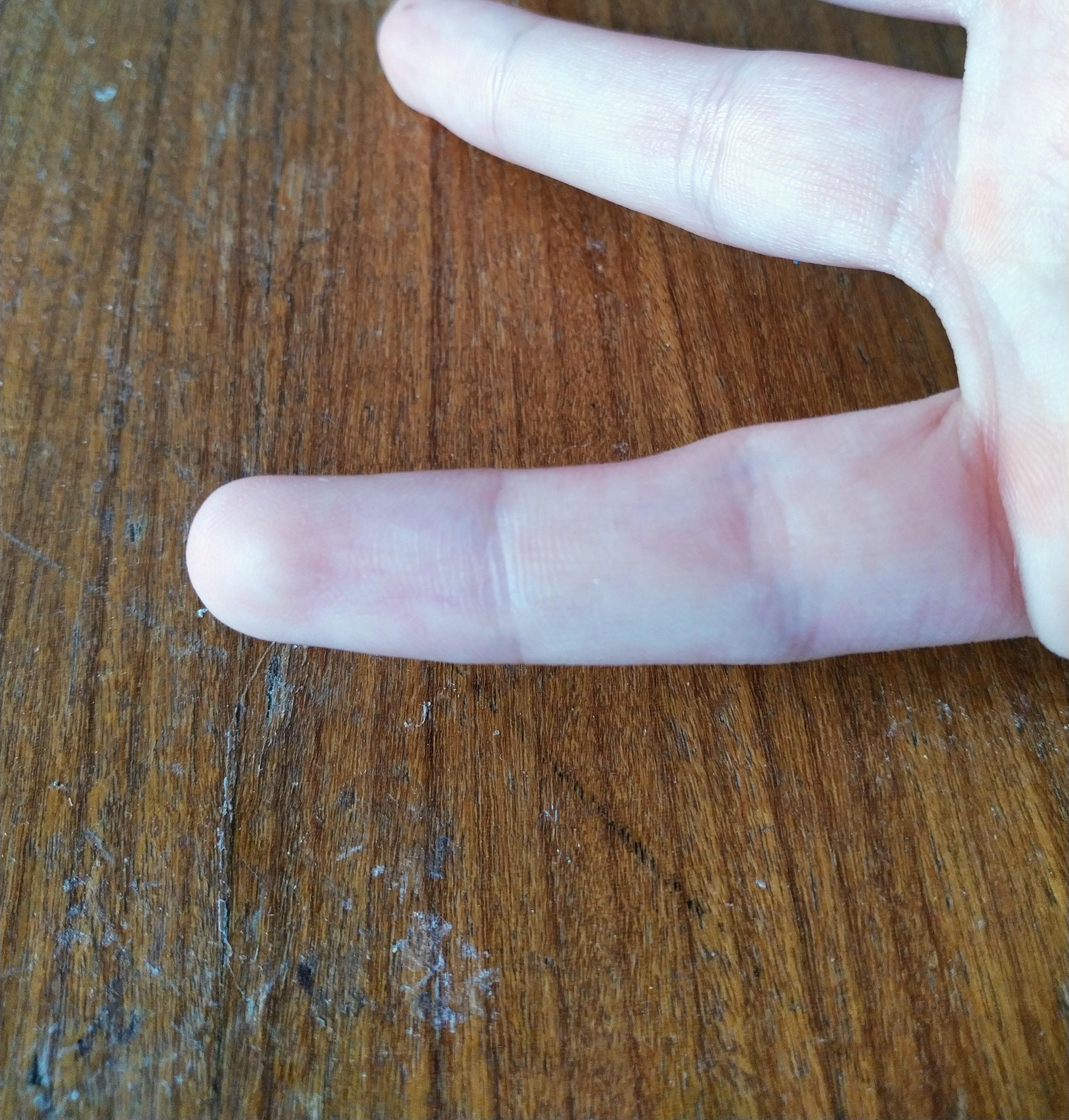 my pinky has a dent in it from my phone resting on it when I watch