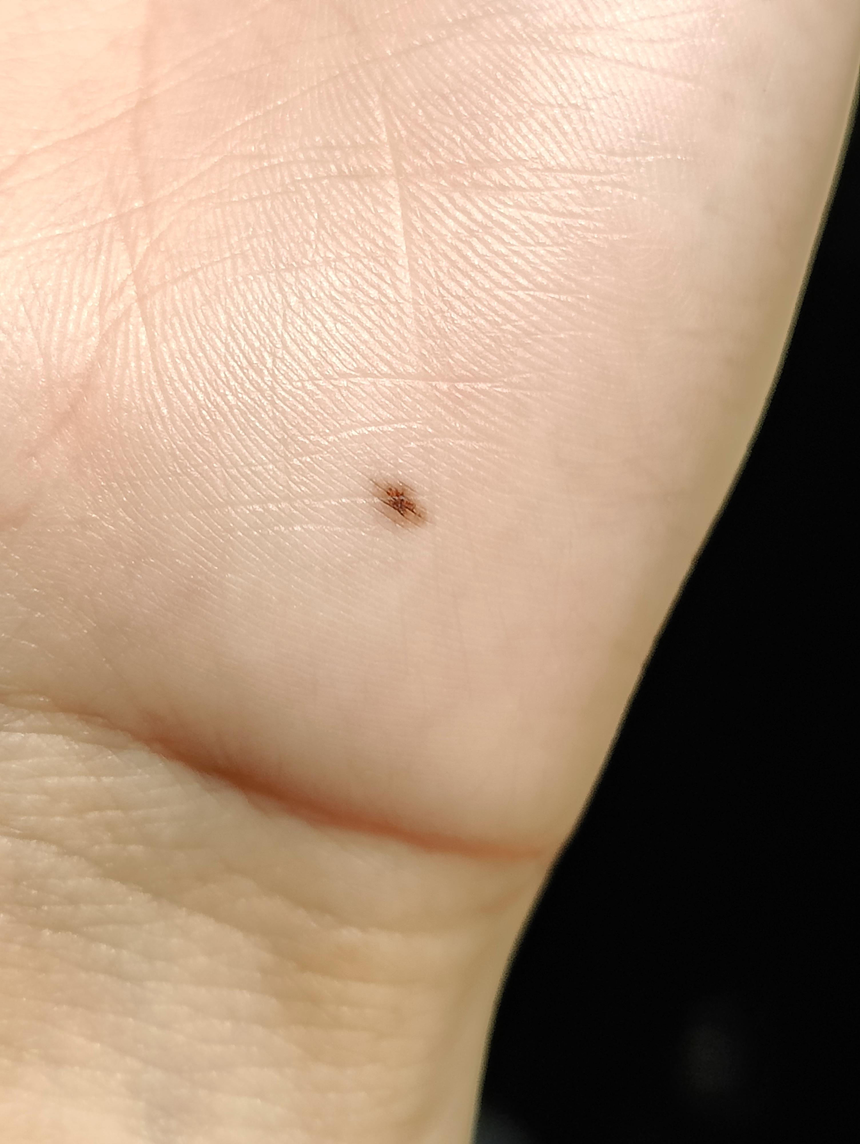 is this a freckle? it appeared on the palm of my hand 3 years ago and
