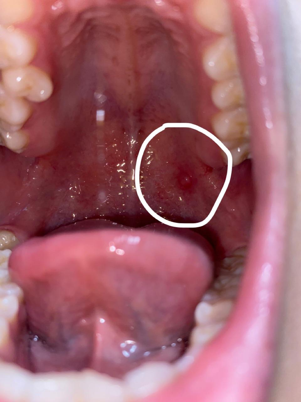 I have a little round bump in the back of my throat. Any tips