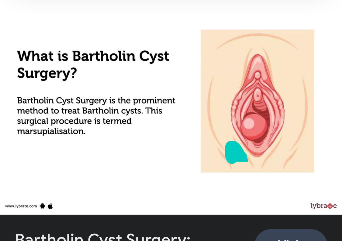 Is this a bartholin cyst ? : r/BartholinCyst