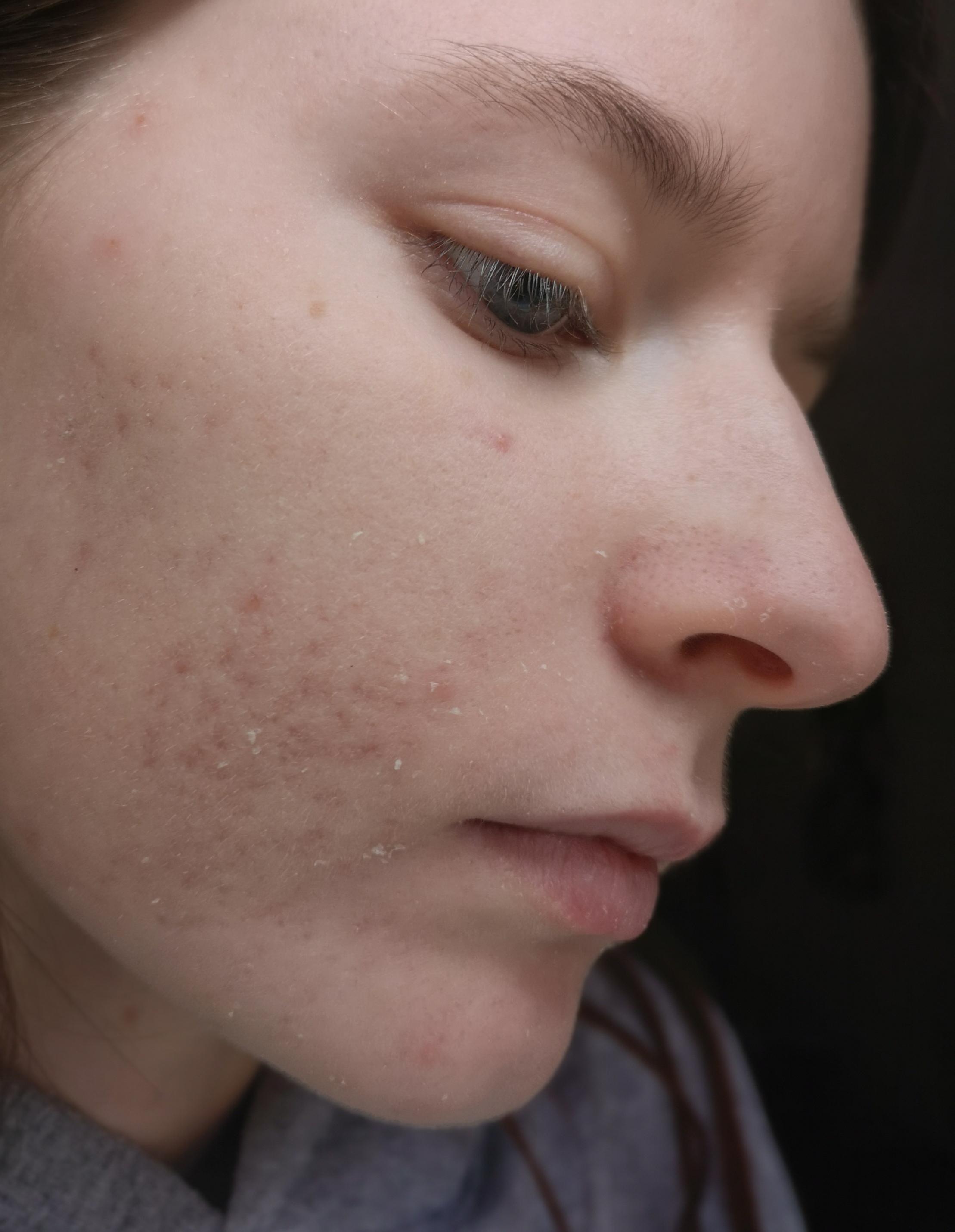 Is it okay to just use epiduo without moisturiser/cleanser? It works