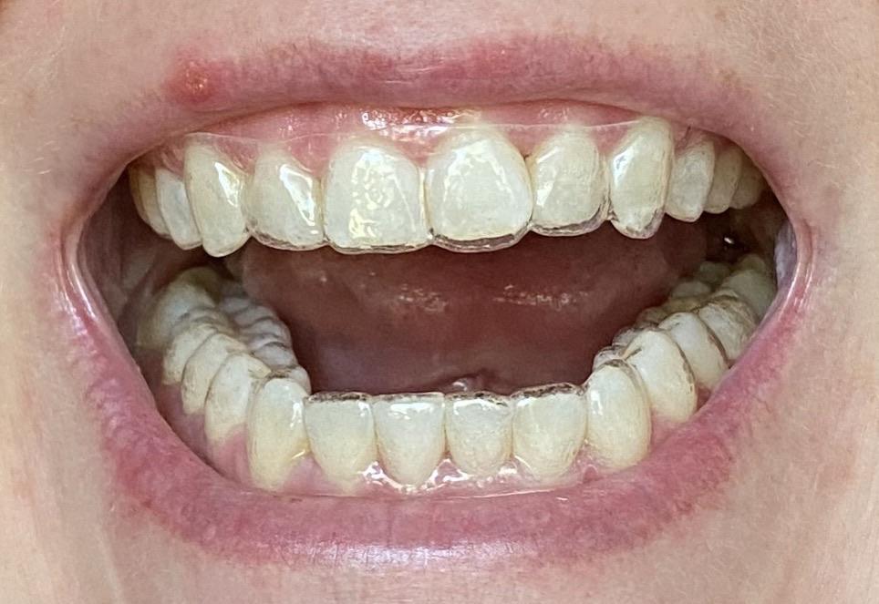Aligners still not tracking after wearing them for nearly 2 weeks (from