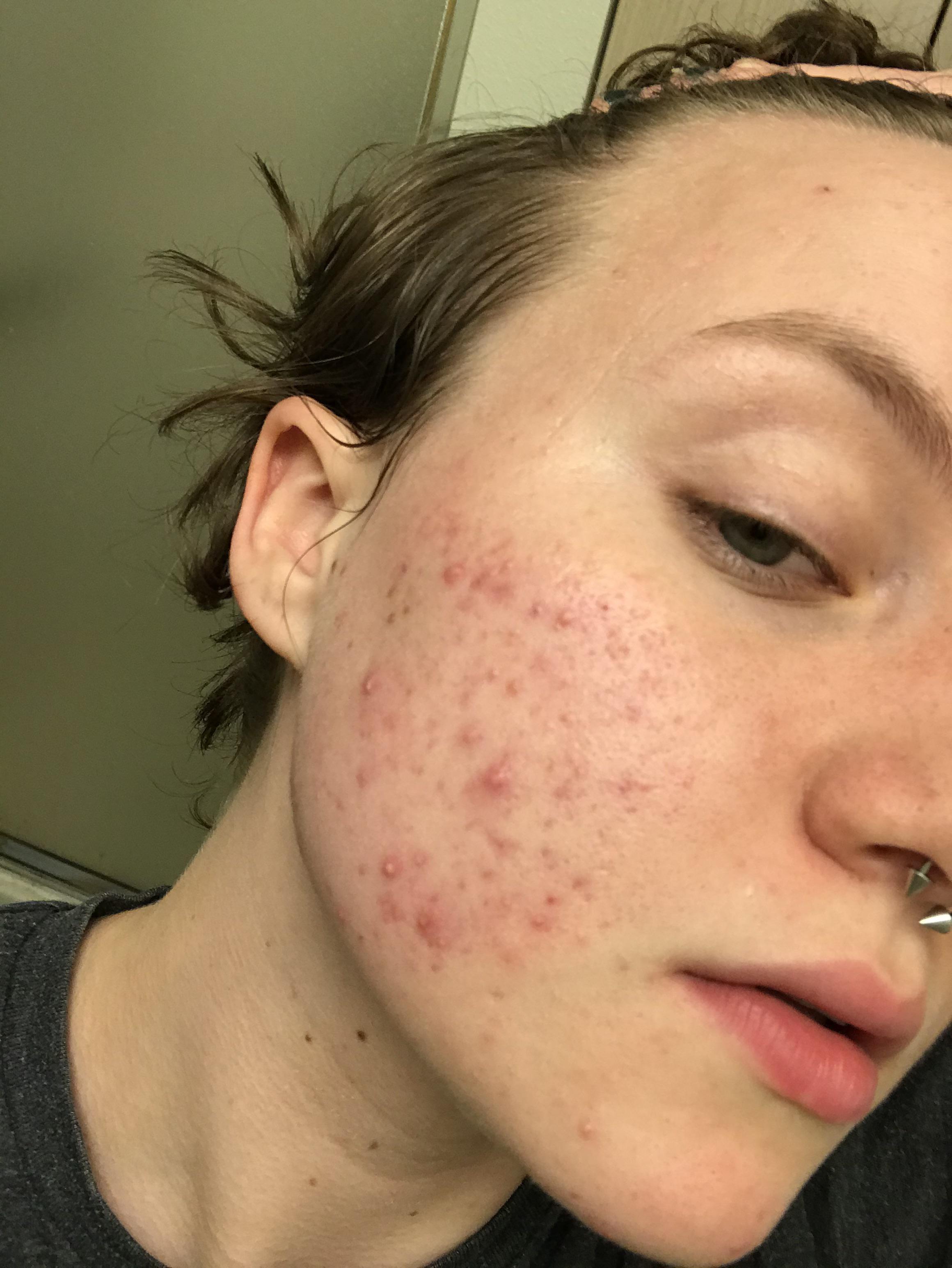 does working out help acne reddit Leann Spangler