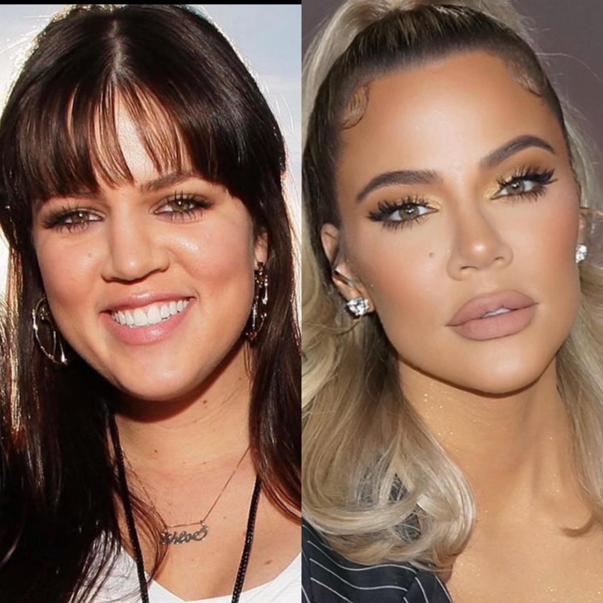 661 best Nose Job images on Pholder Botchedsurgeries, Plastic Surgery