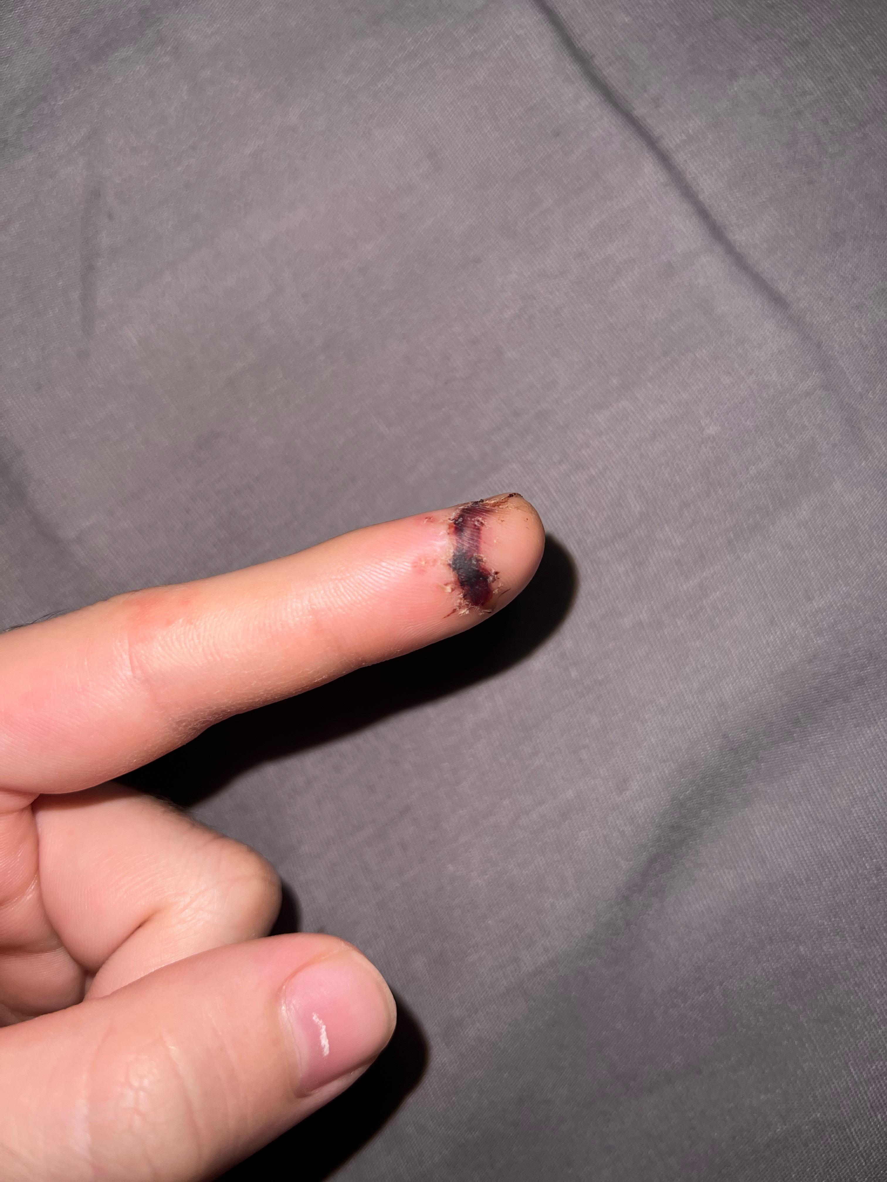 Is this infected ?? Got stitches taken out 6/5/22, I don’t have pain from it but my half my