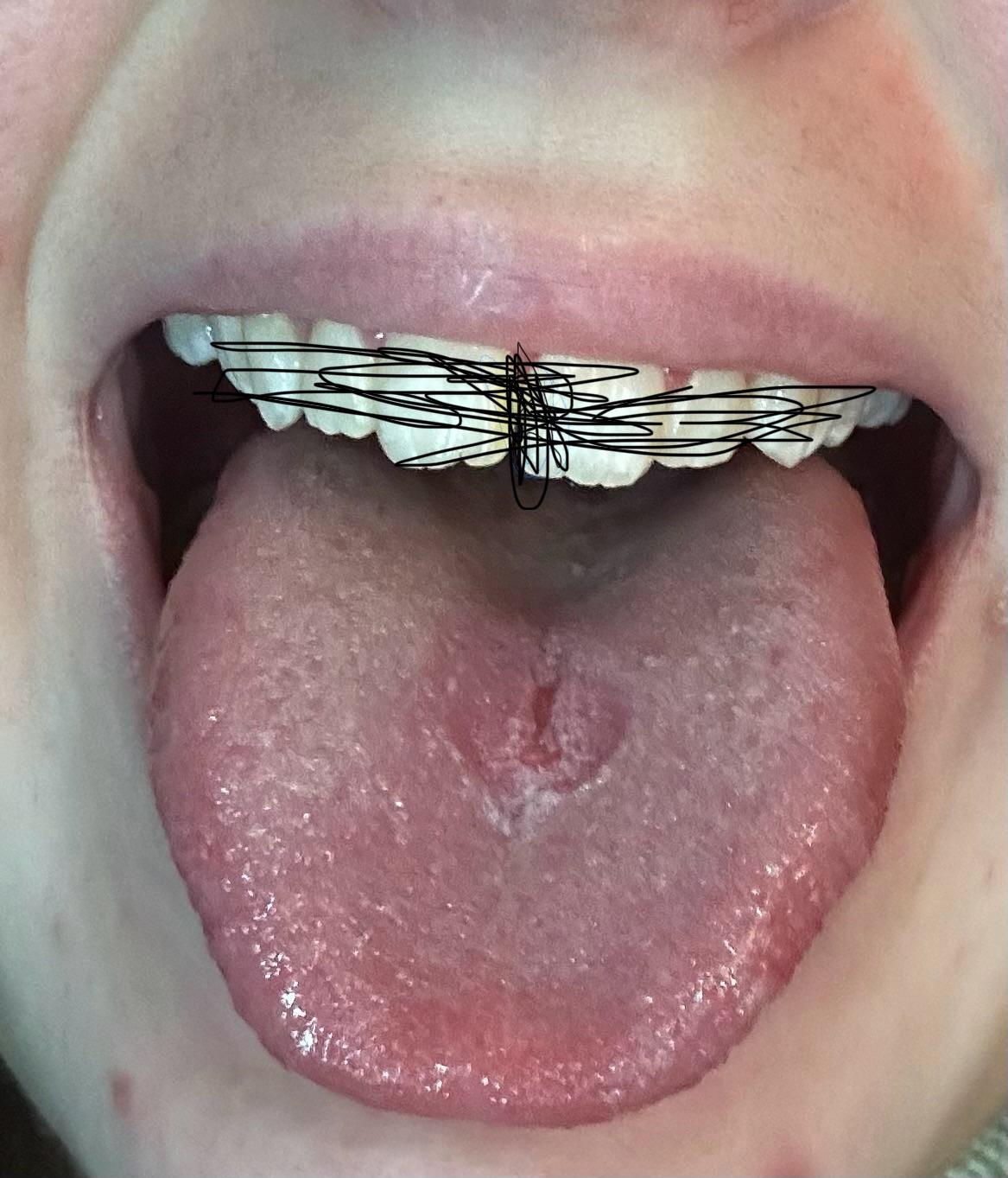 tongue piercing hurts after two years, does this look okay or should i