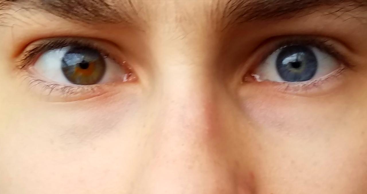 One eye brown, one eye blue r/heterochromia