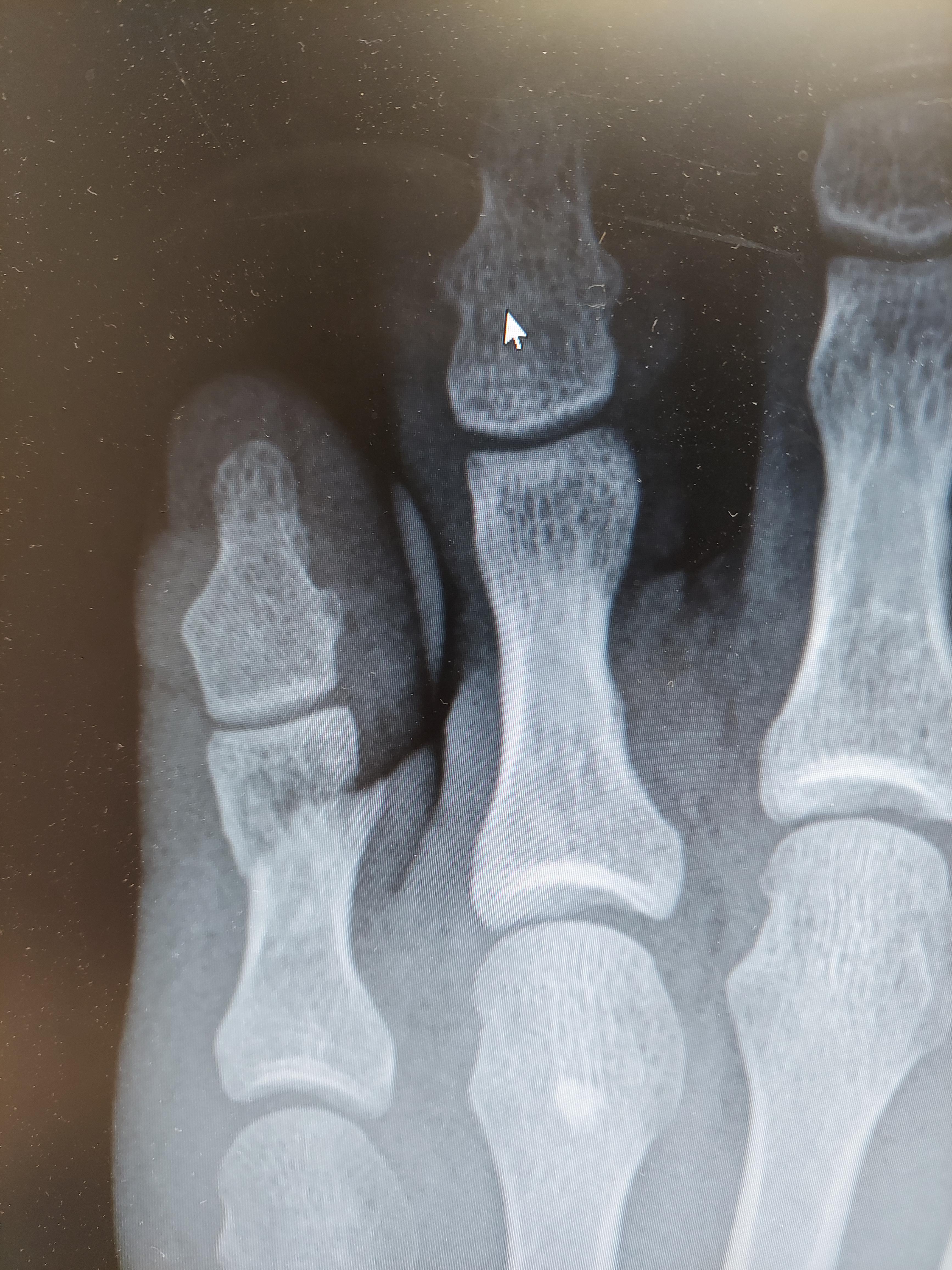 Fractured my toe. Xray revealed my distal and middle phalanges have