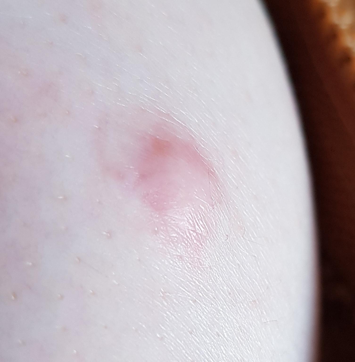 Advice on soothing itchy keloid scar? r/TheGirlSurvivalGuide