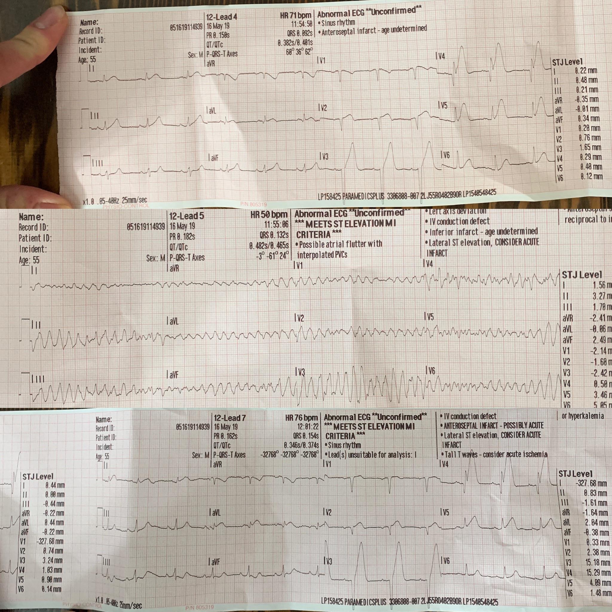 Yesterday I posted the 12 lead that captured our pt slipping into VFib
