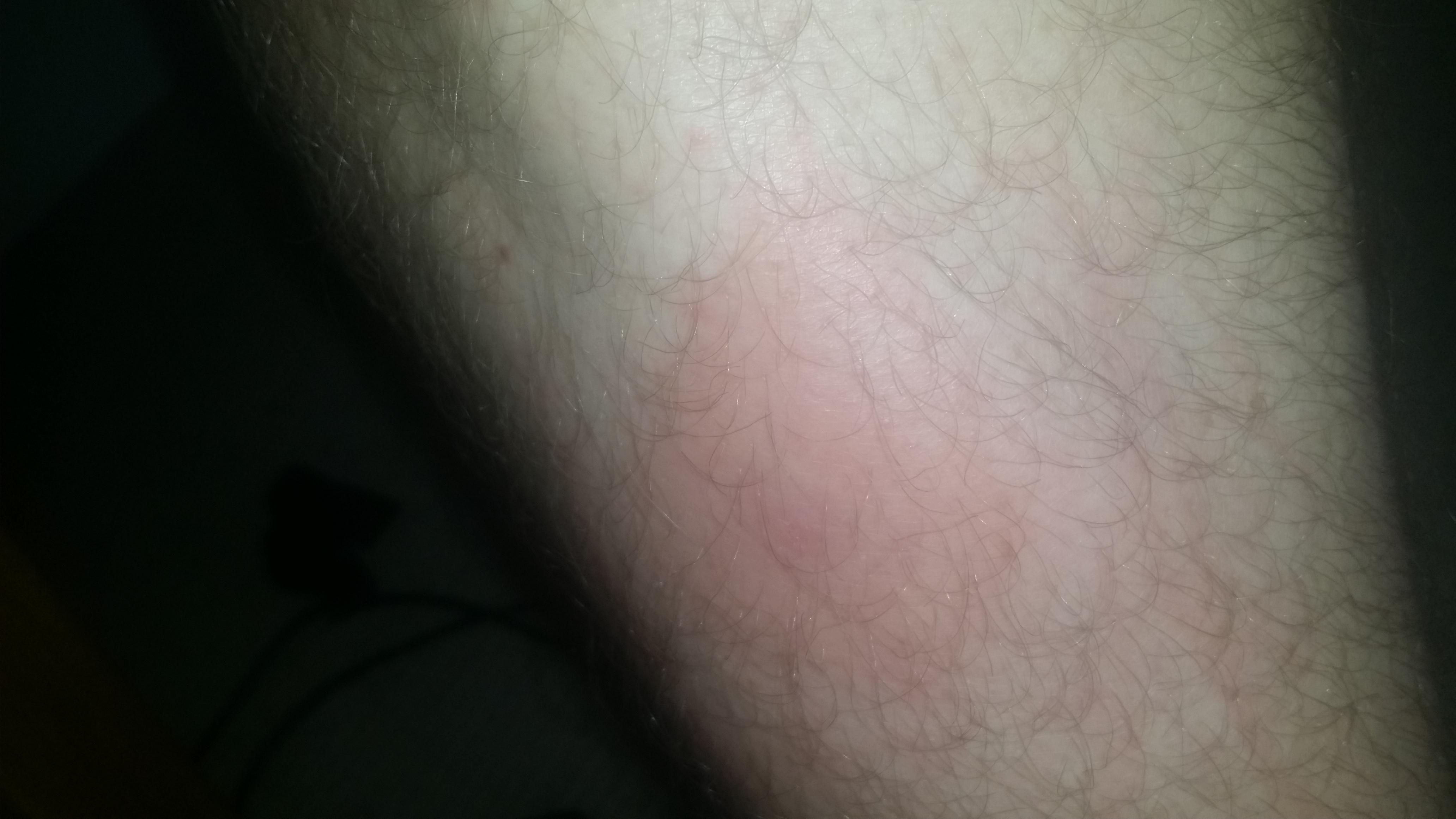Bite on Leg from about 57 days ago. Swollen to about 3