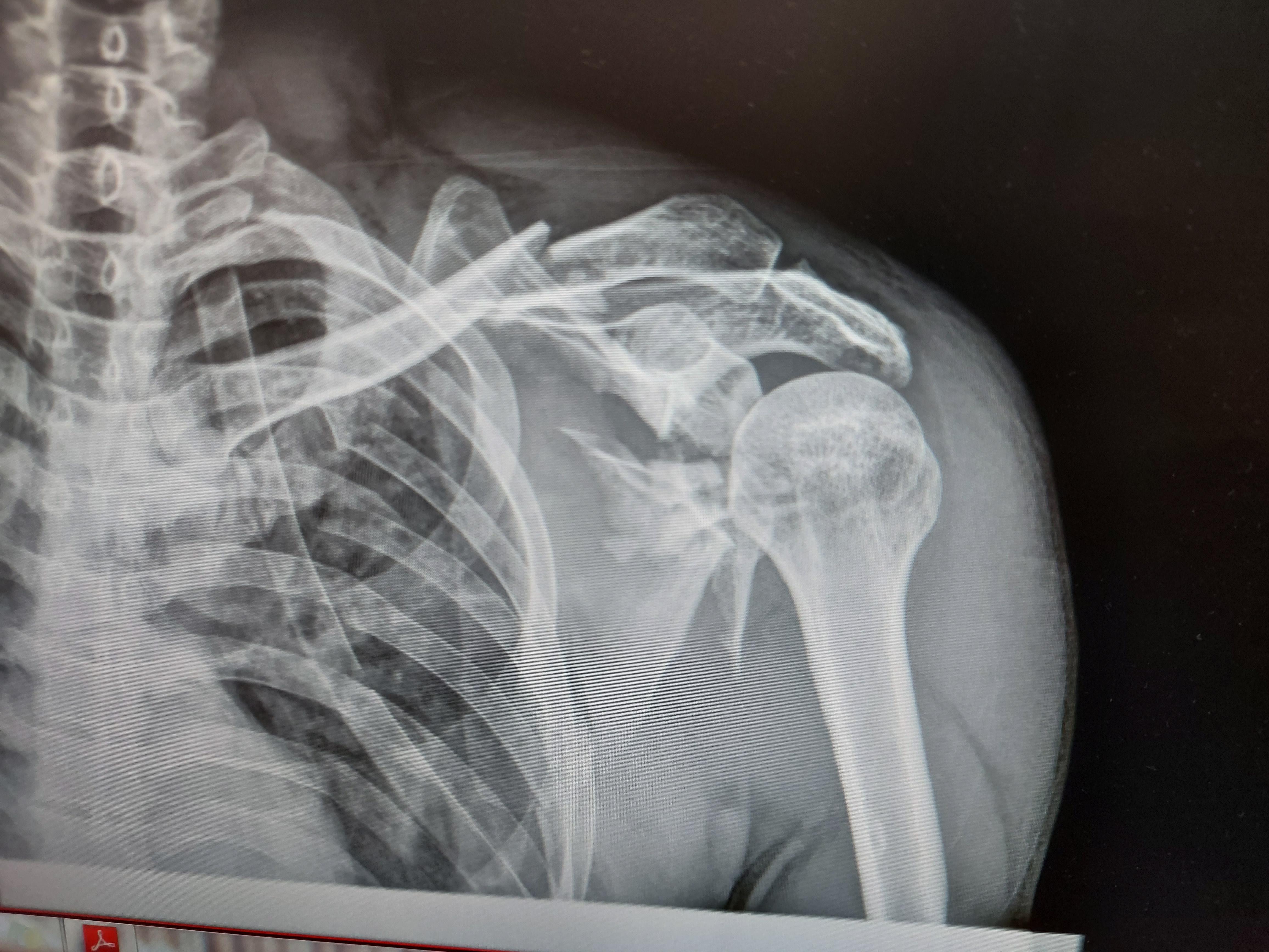 Comminuted Scapular Fracture