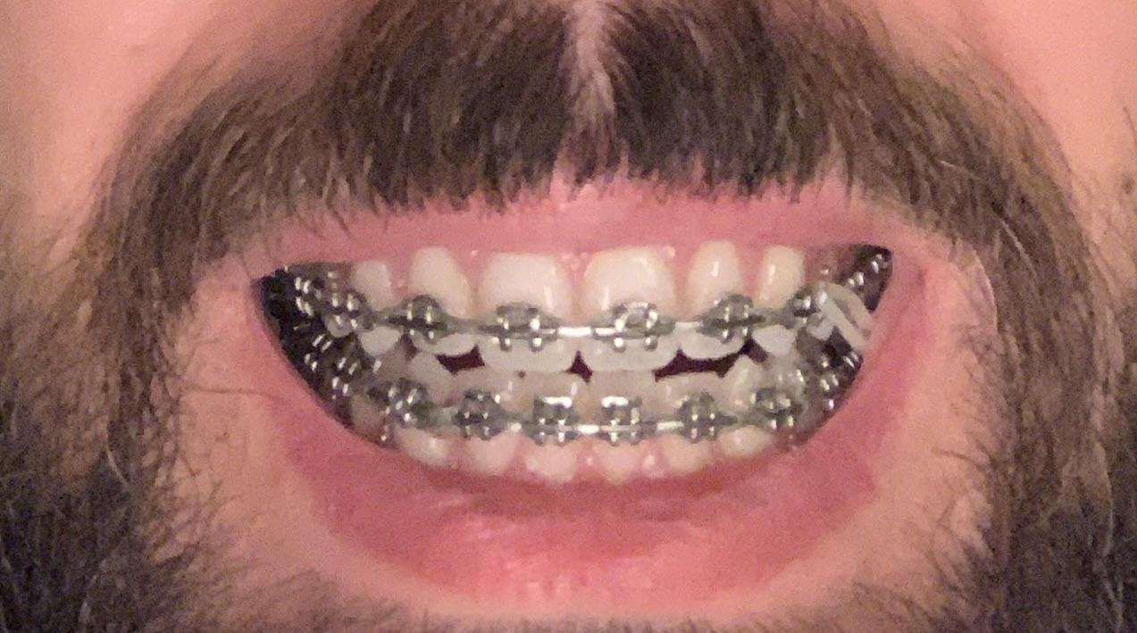 Slice of pizza broke two brackets close to end of treatment r/braces
