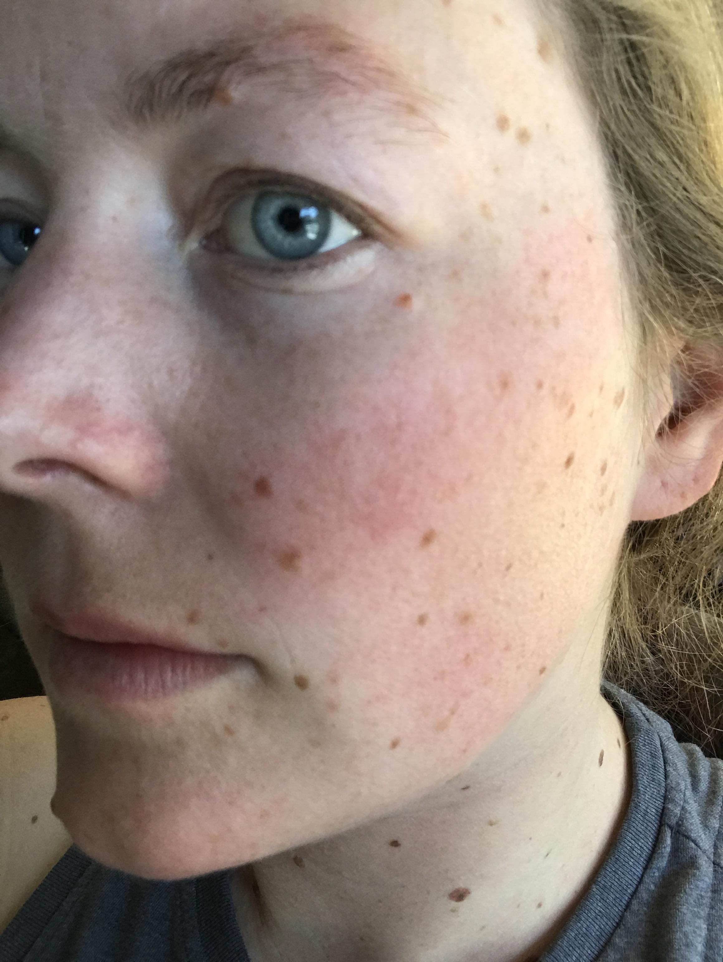 I have mild rosacea and a PABA allergy please products for my