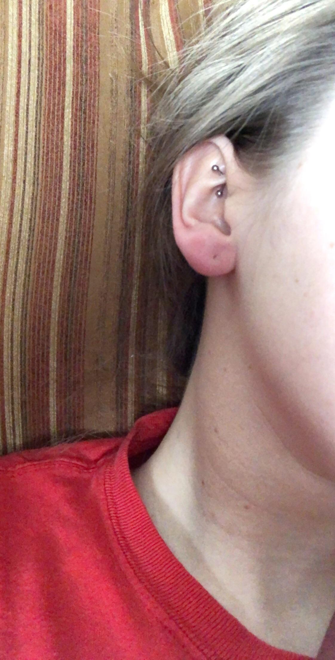 Month Old Ear Lobe Piercing With Large Bump Above Does This Just Look