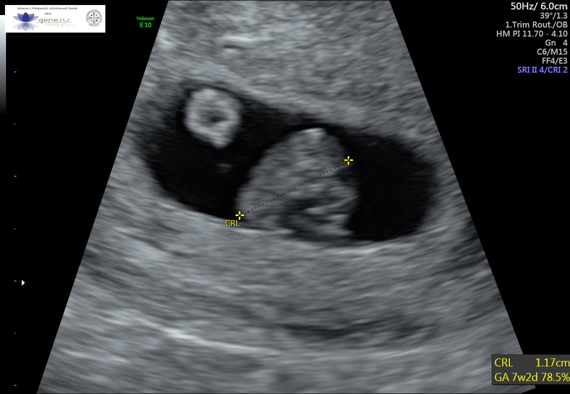 I am so happy! Baby 3 has a heartbeat of 153 BPM! BabyBumps