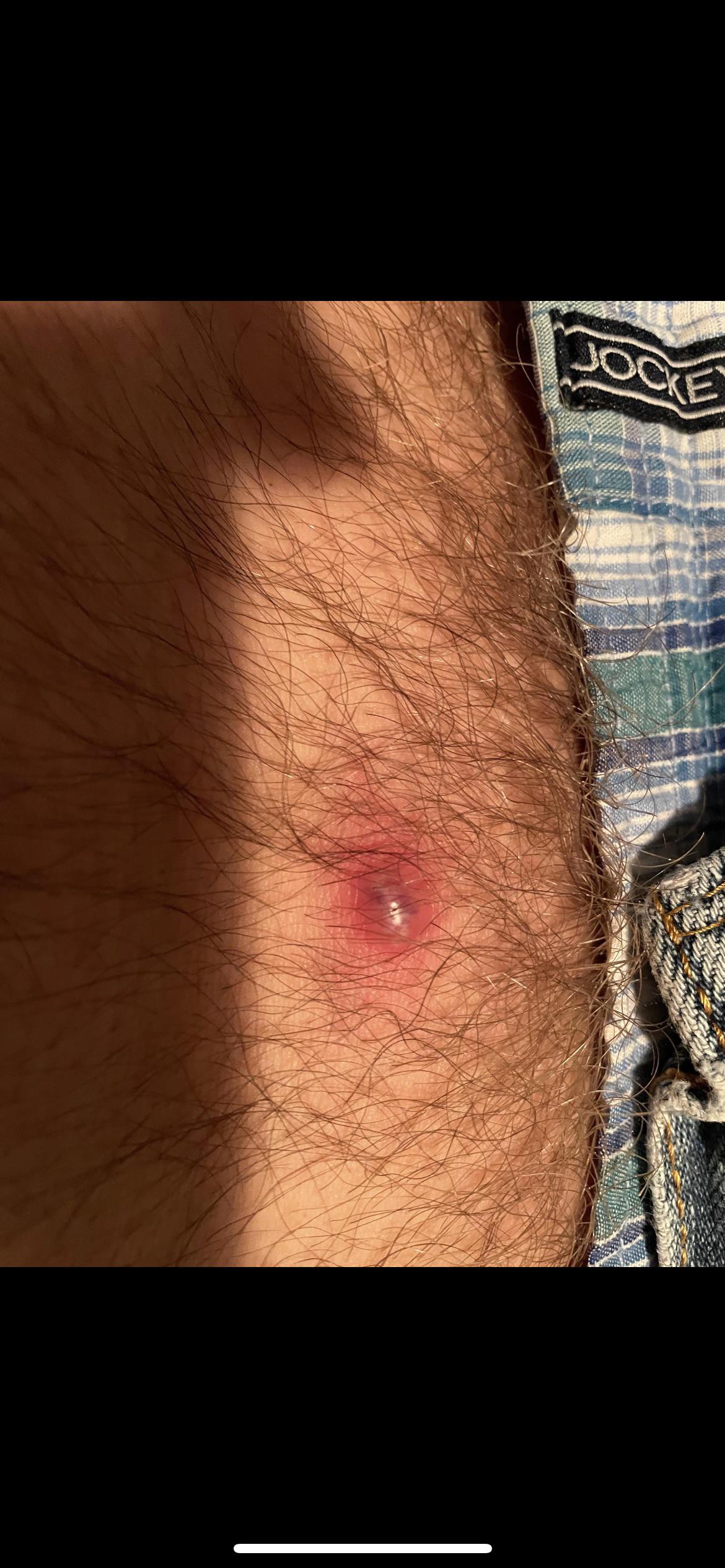 I believe this is an ingrown hair cyst. How long do I have to wait till