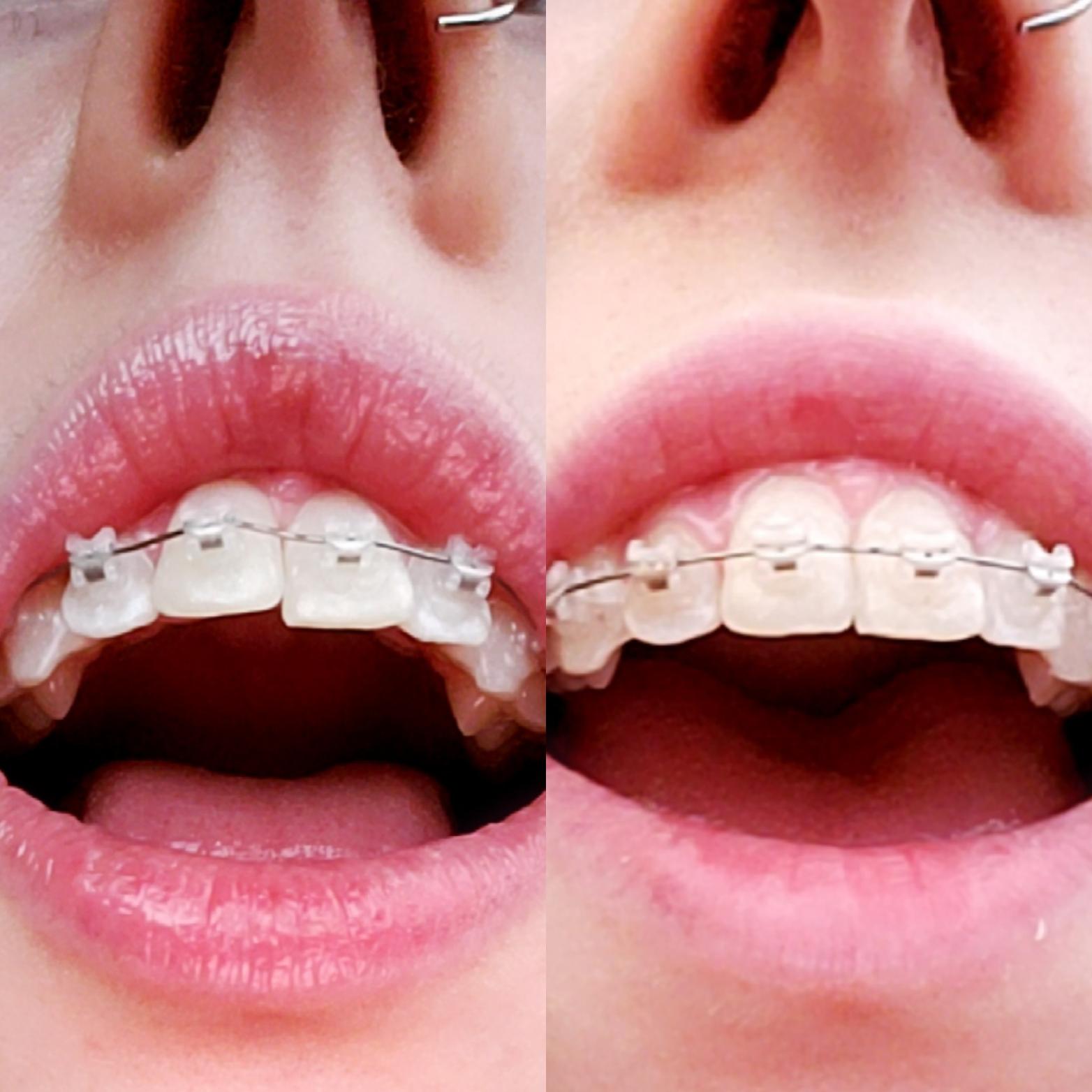 Braces be crazy. (26 y/o, top teeth, 1 week) r/braces