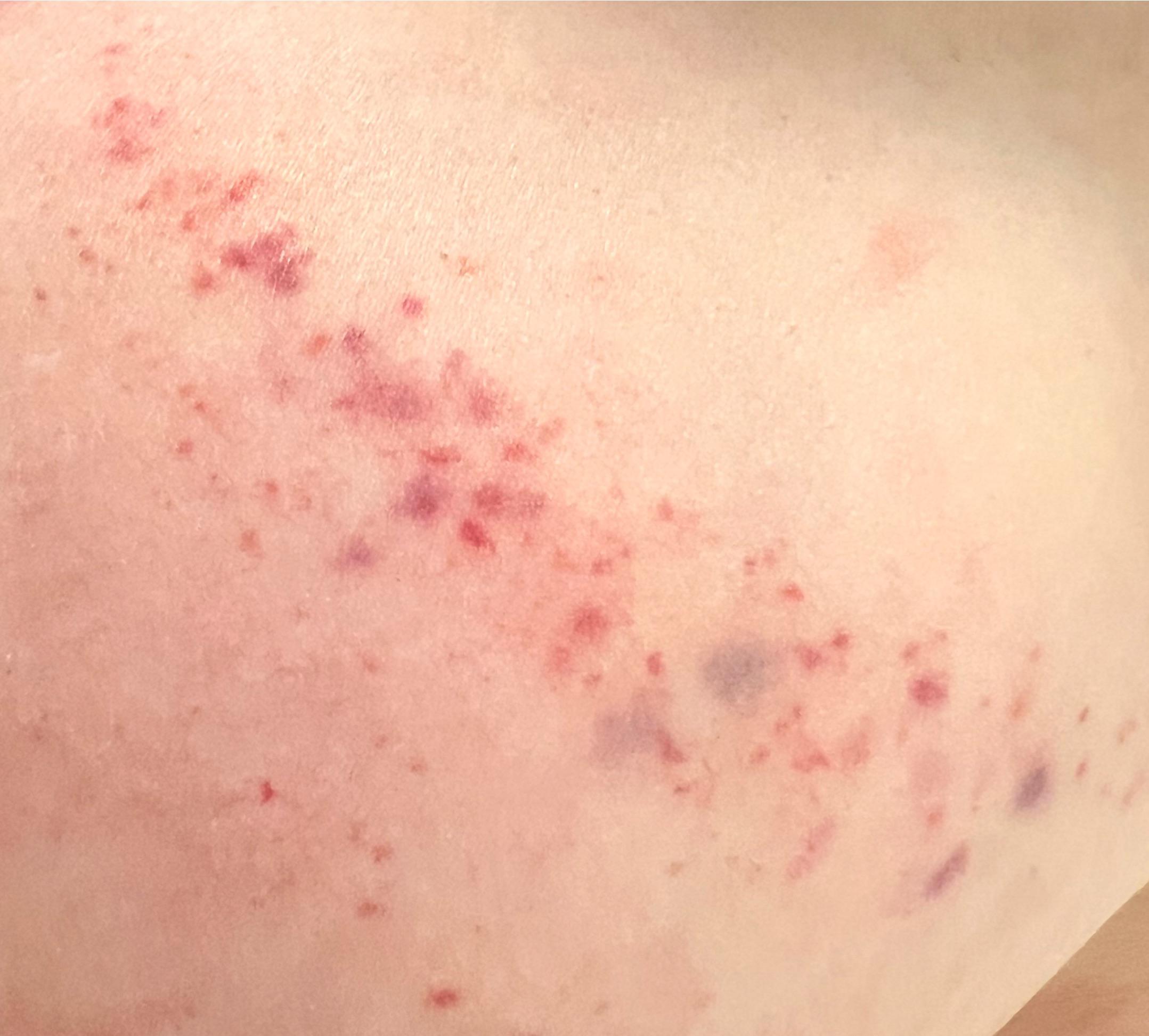 24F have been having weird rashes on full chest below neck recently
