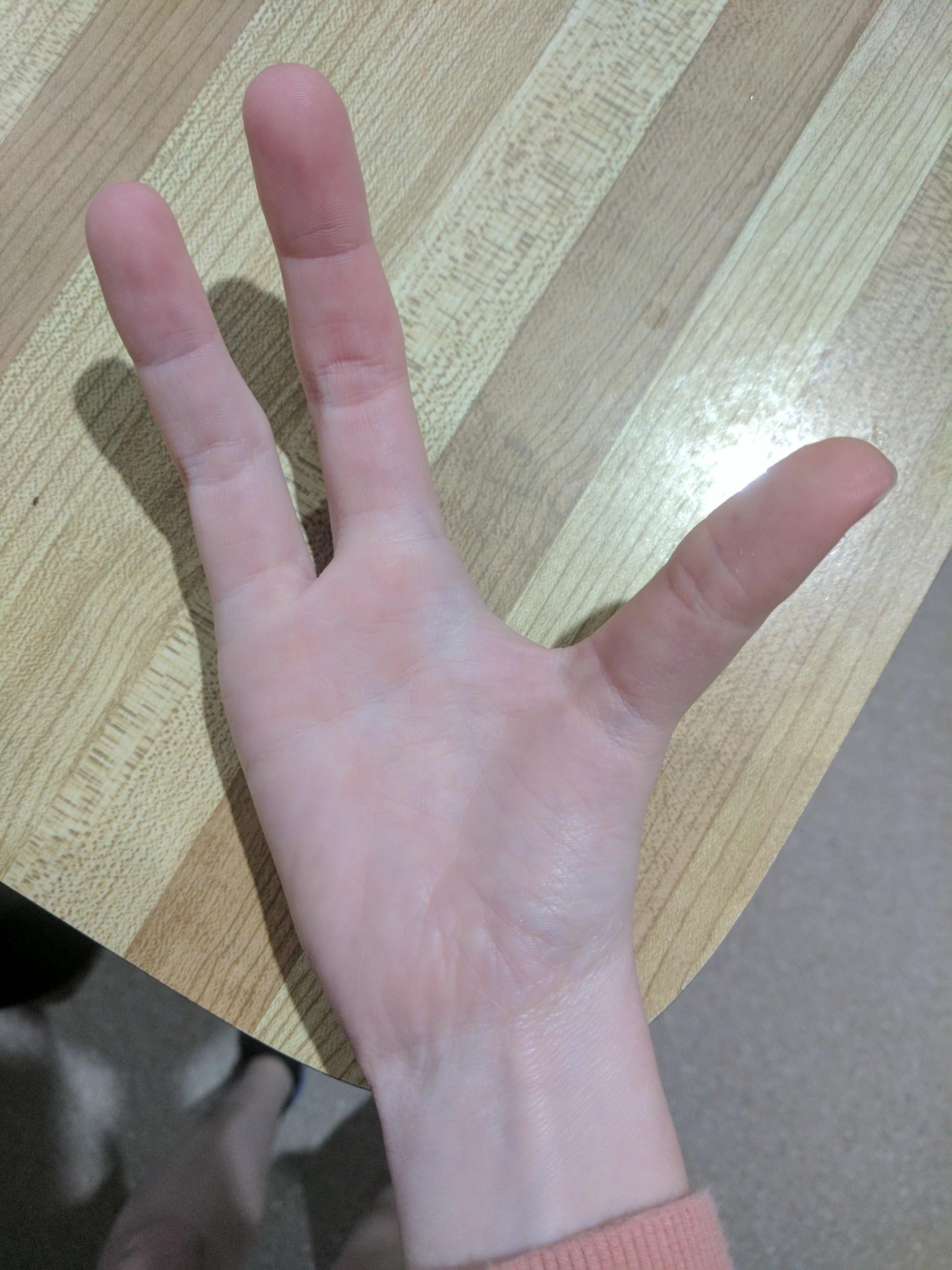 I was born missing my right pinky and thumb r/pics