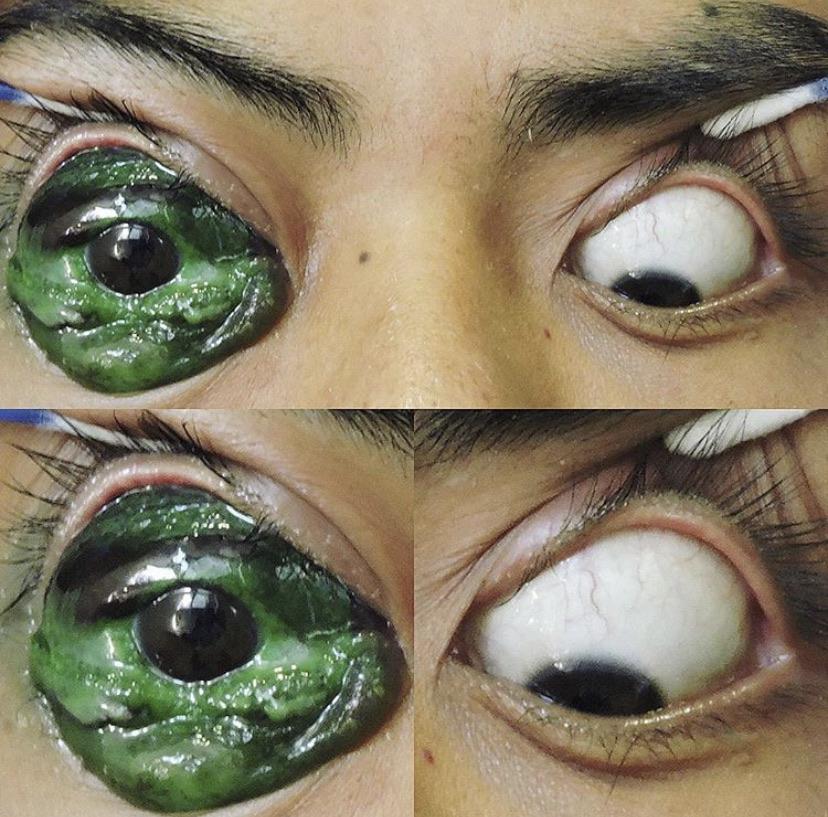 Scleral tattoo gone wrong. oddlyterrifying