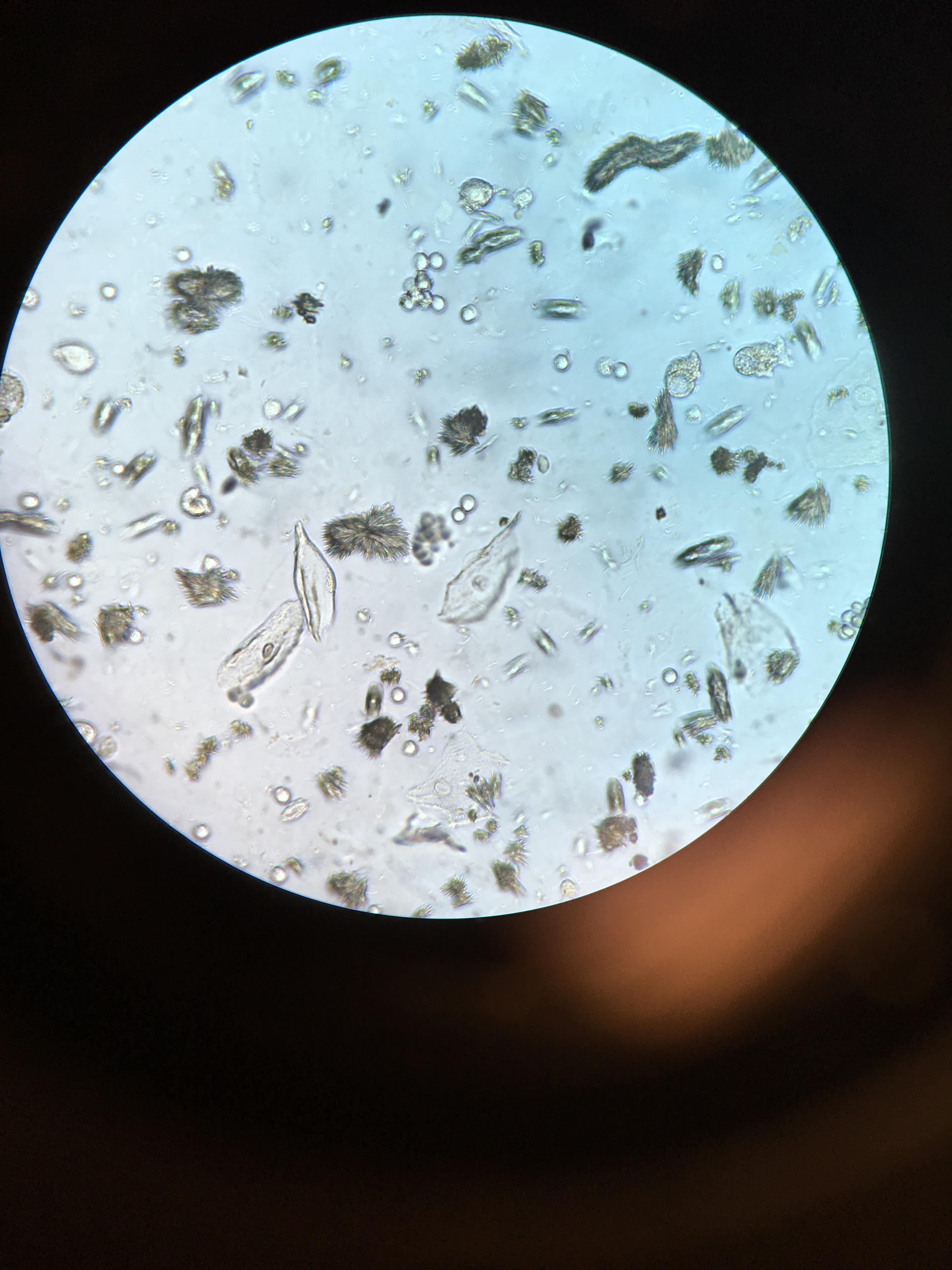 Tyrosine Crystals In Urine