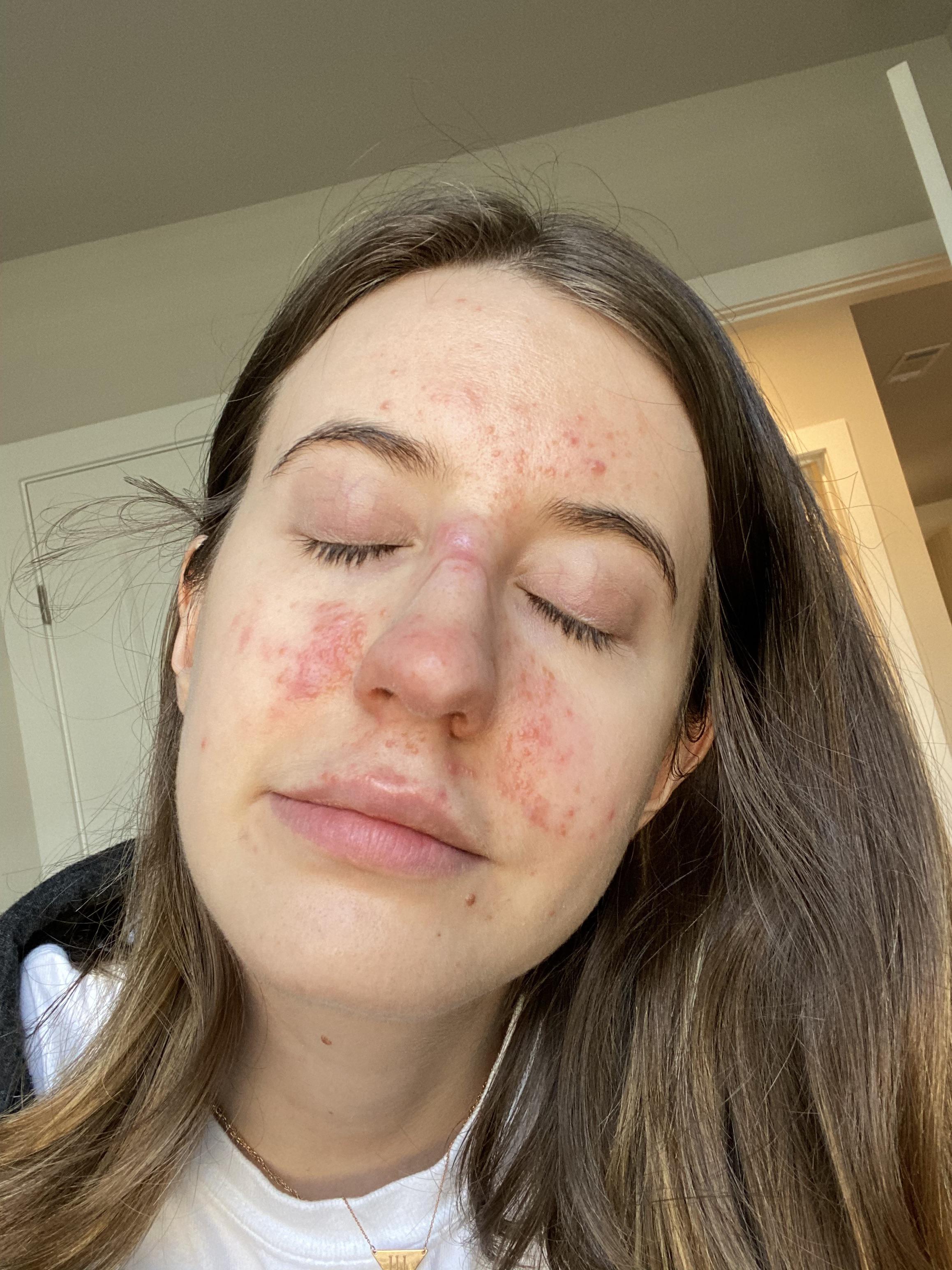 Does this look like demodex? I’m on a compound triple cream (1