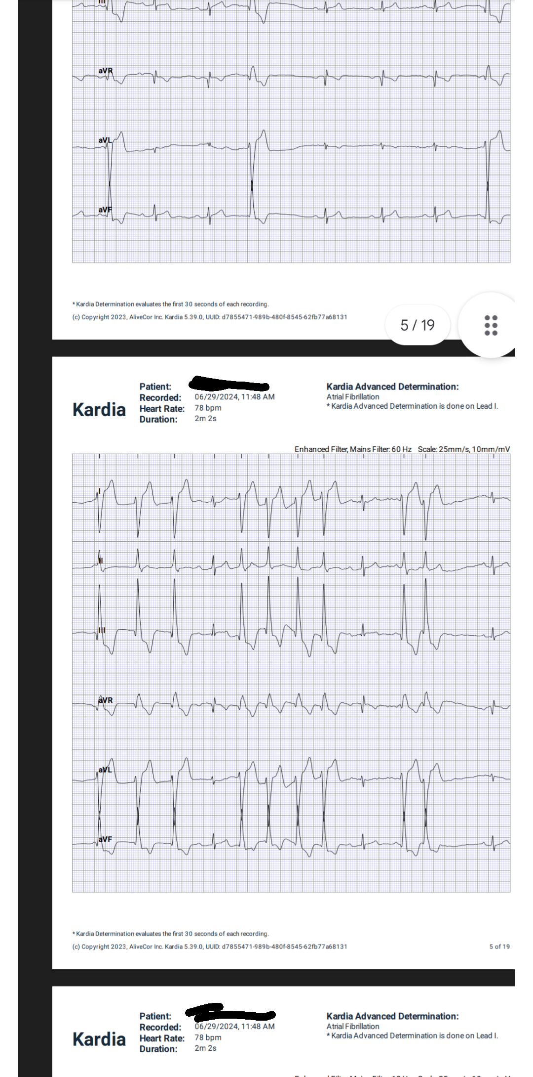 Had an episode of AFib my device told me with PVC. How serious is this