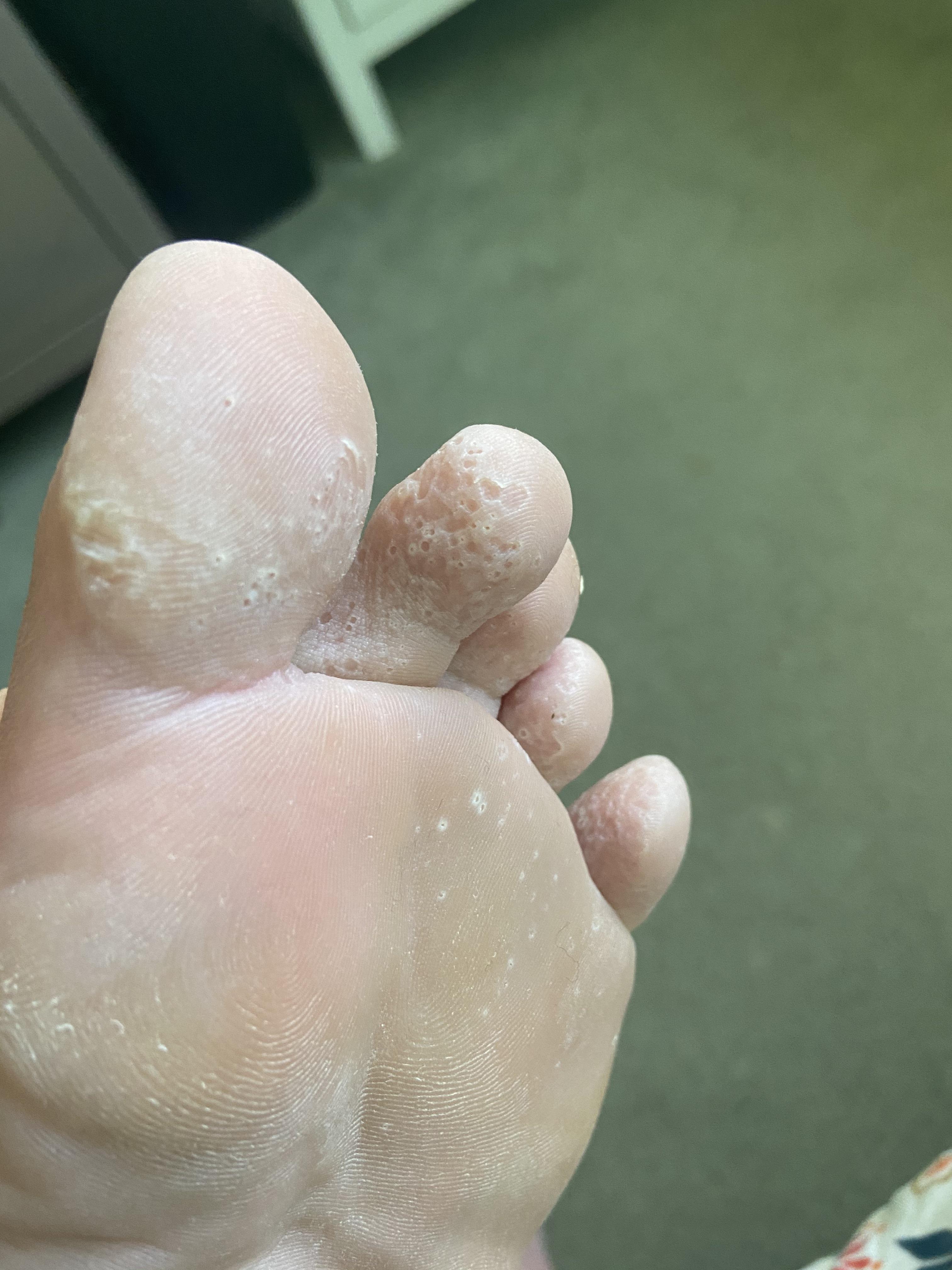 Could this be Pitted Keratolysis?! r/medical