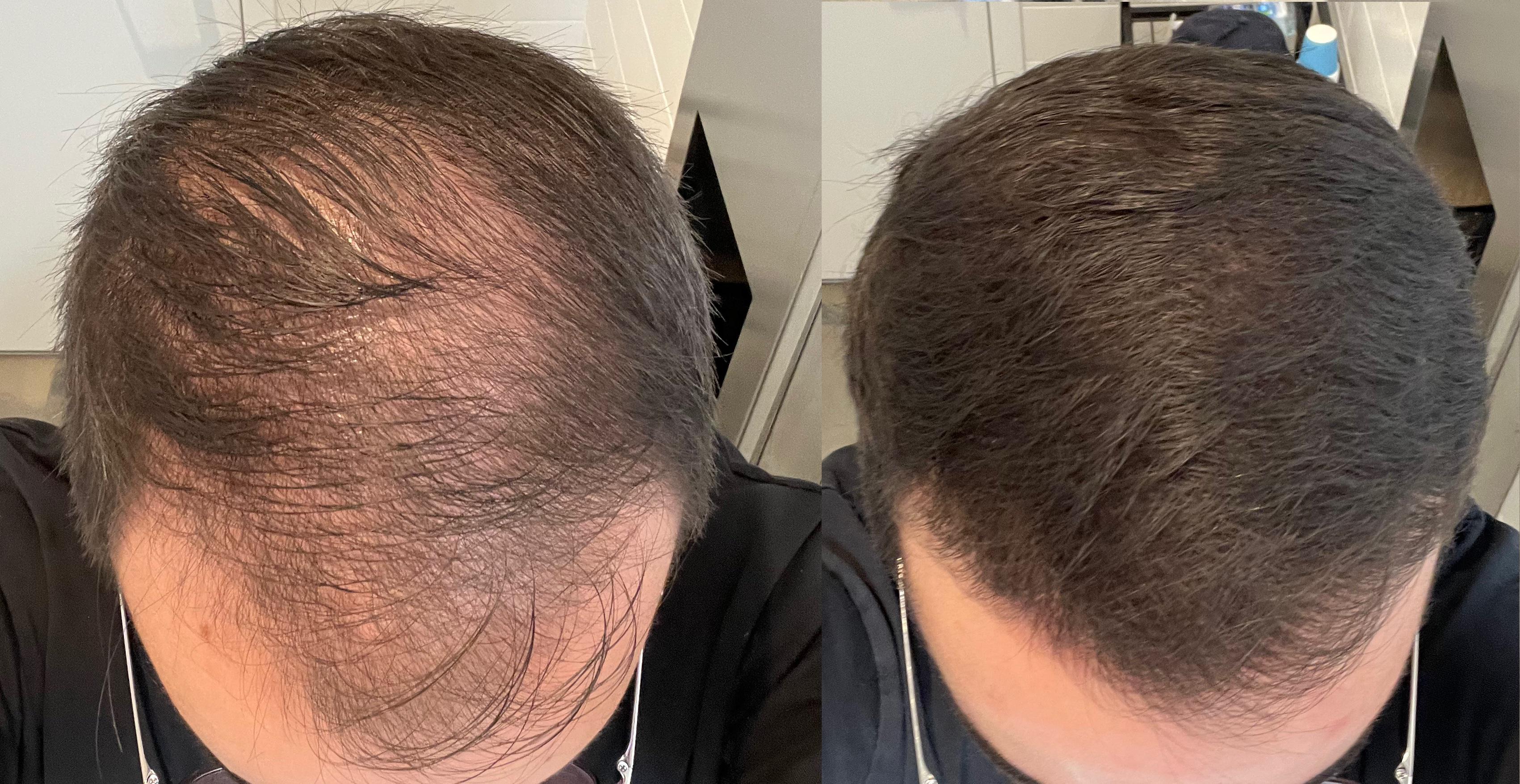 5 Months Results Fin/Min/Keto Shampoo/Dermapen r/tressless