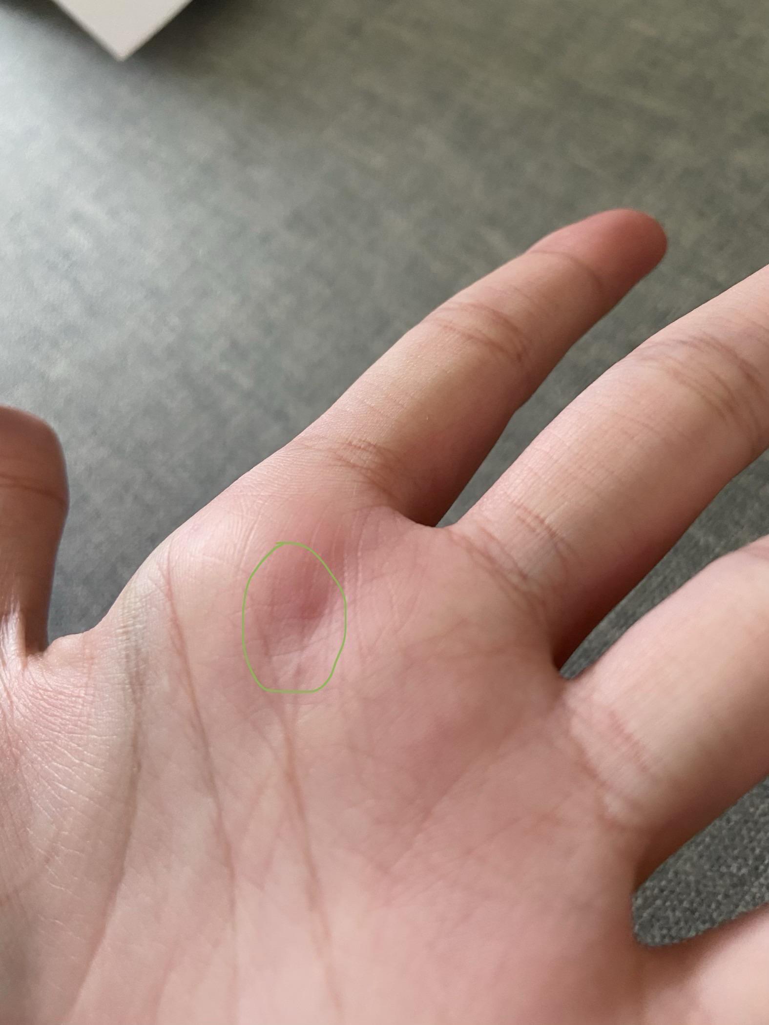 what this bump on hand hurts when i touch it i have a similar one on finger r/medical_advice