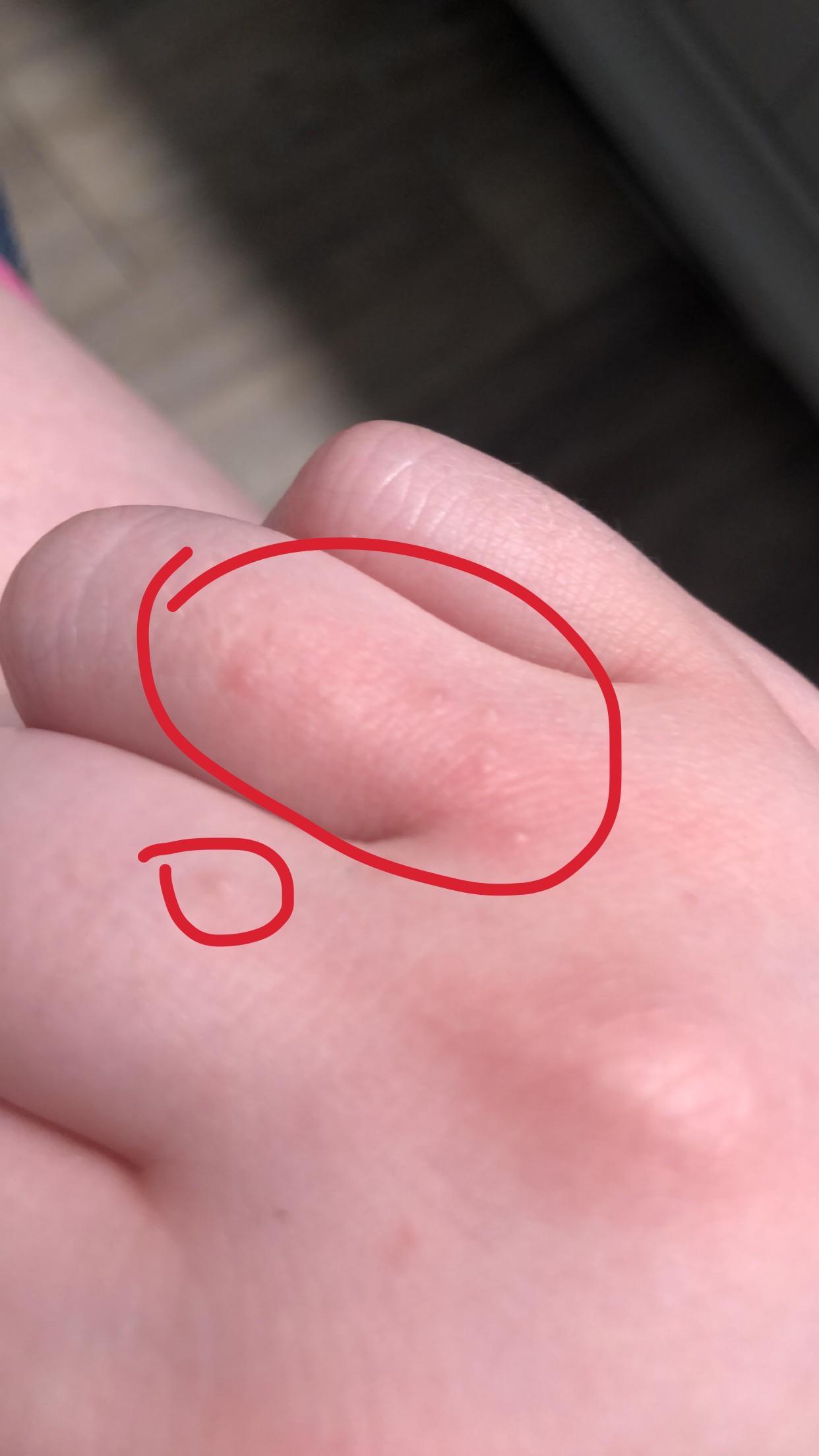 Tiny, itchy bumps on my hand; what are they? r/medical_advice