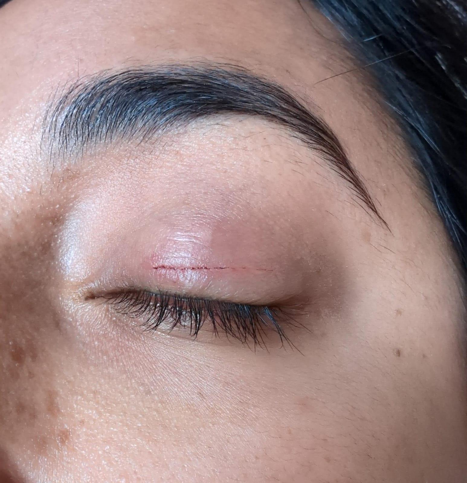 Cat scratched my GF's eyelid r/medical_advice