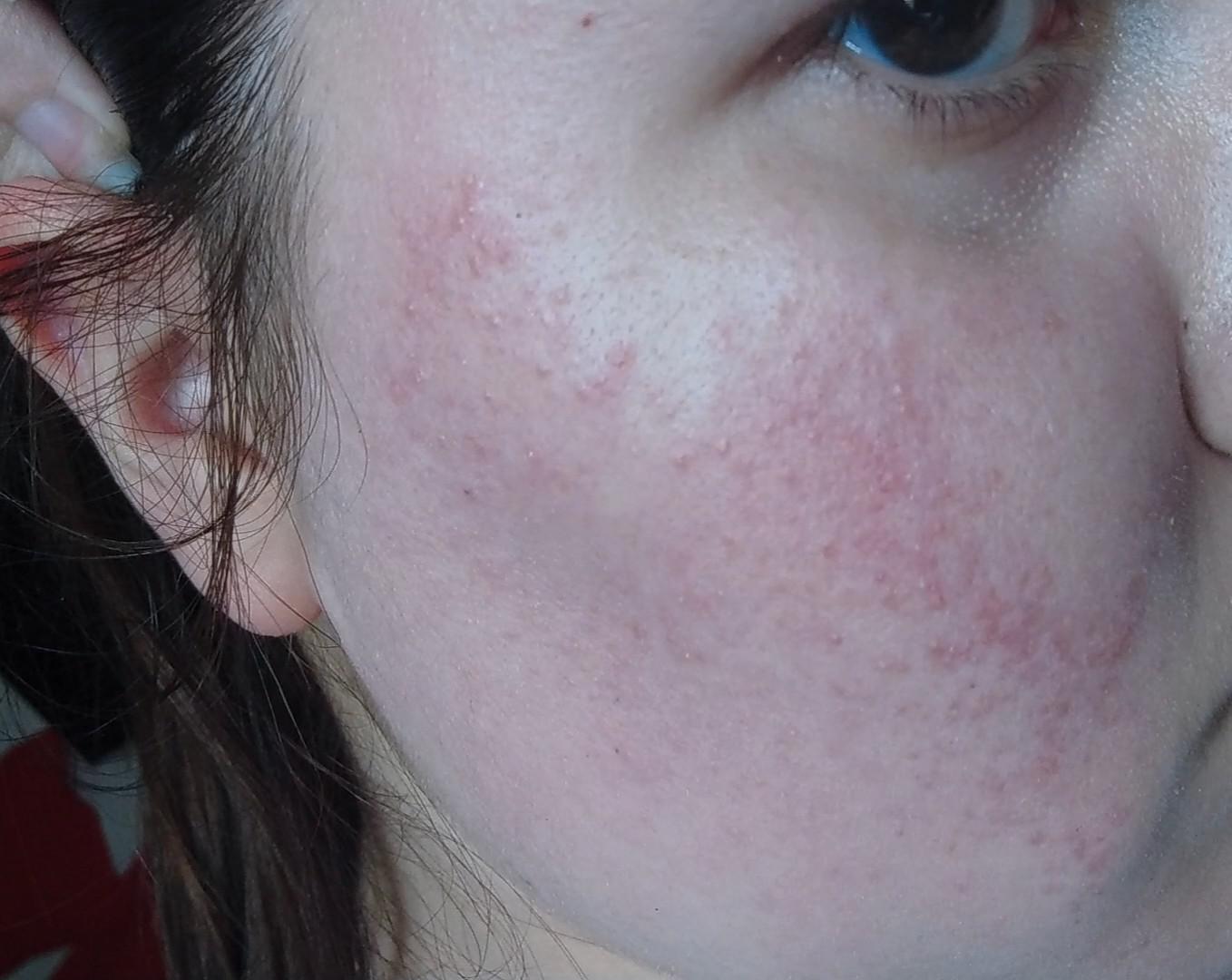 Is that rosacea ? It's been on both of my cheeks for months now
