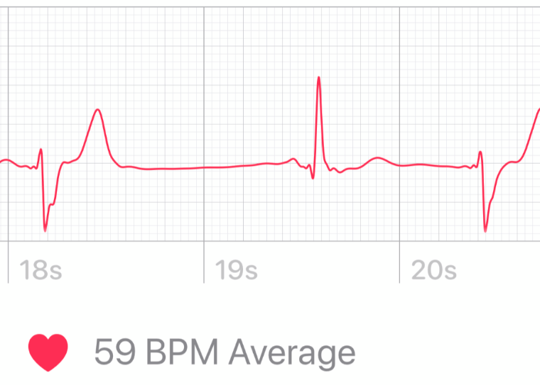 Irregular Heartbeat r/medical_advice