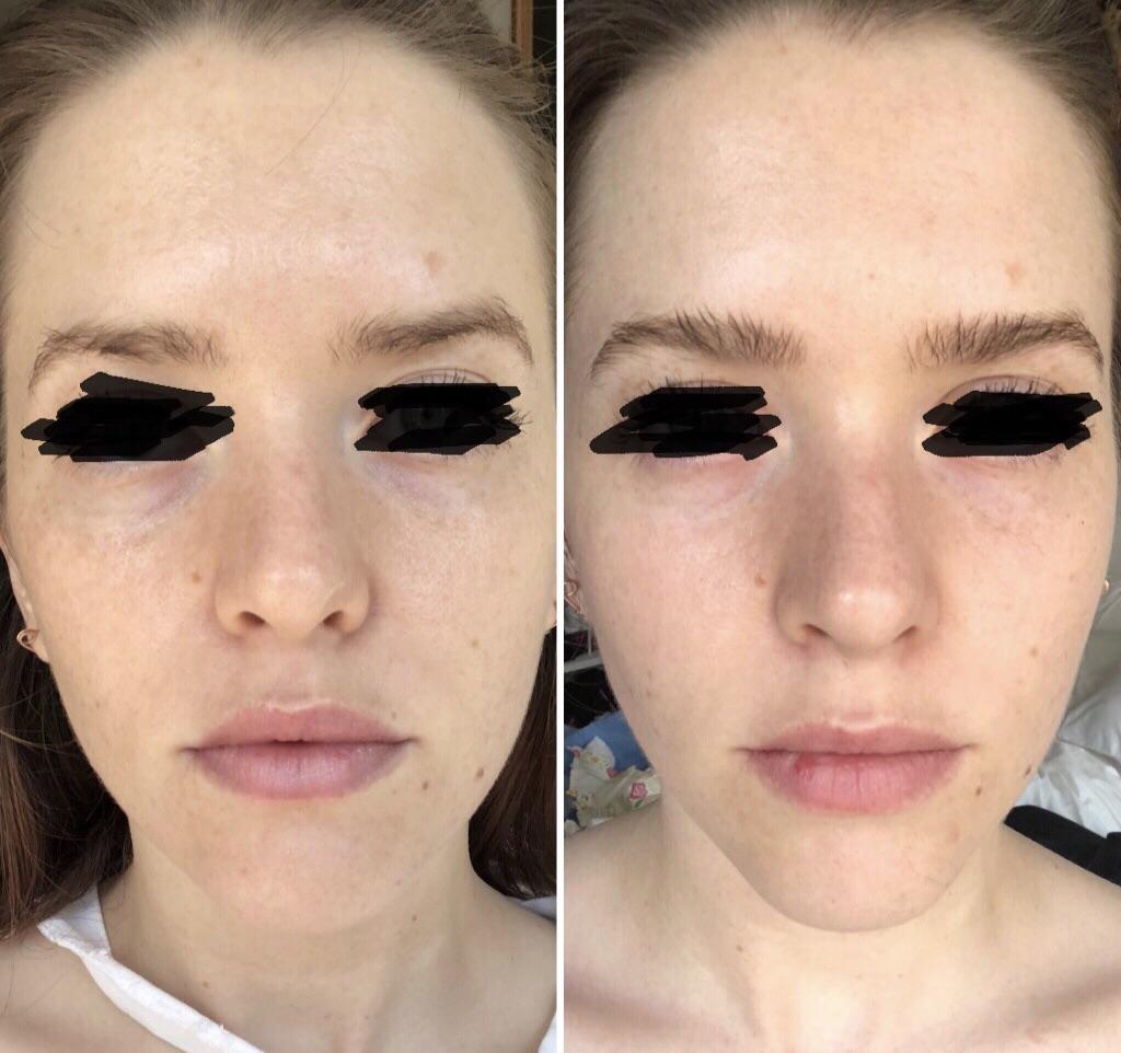 Ipl Face Treatment Before After Doctor Heck