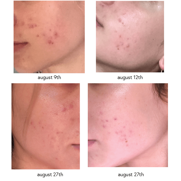 [Routine Help] Is Azelaic Acid okay to use on hyperpigmentation if skin is coming back from over
