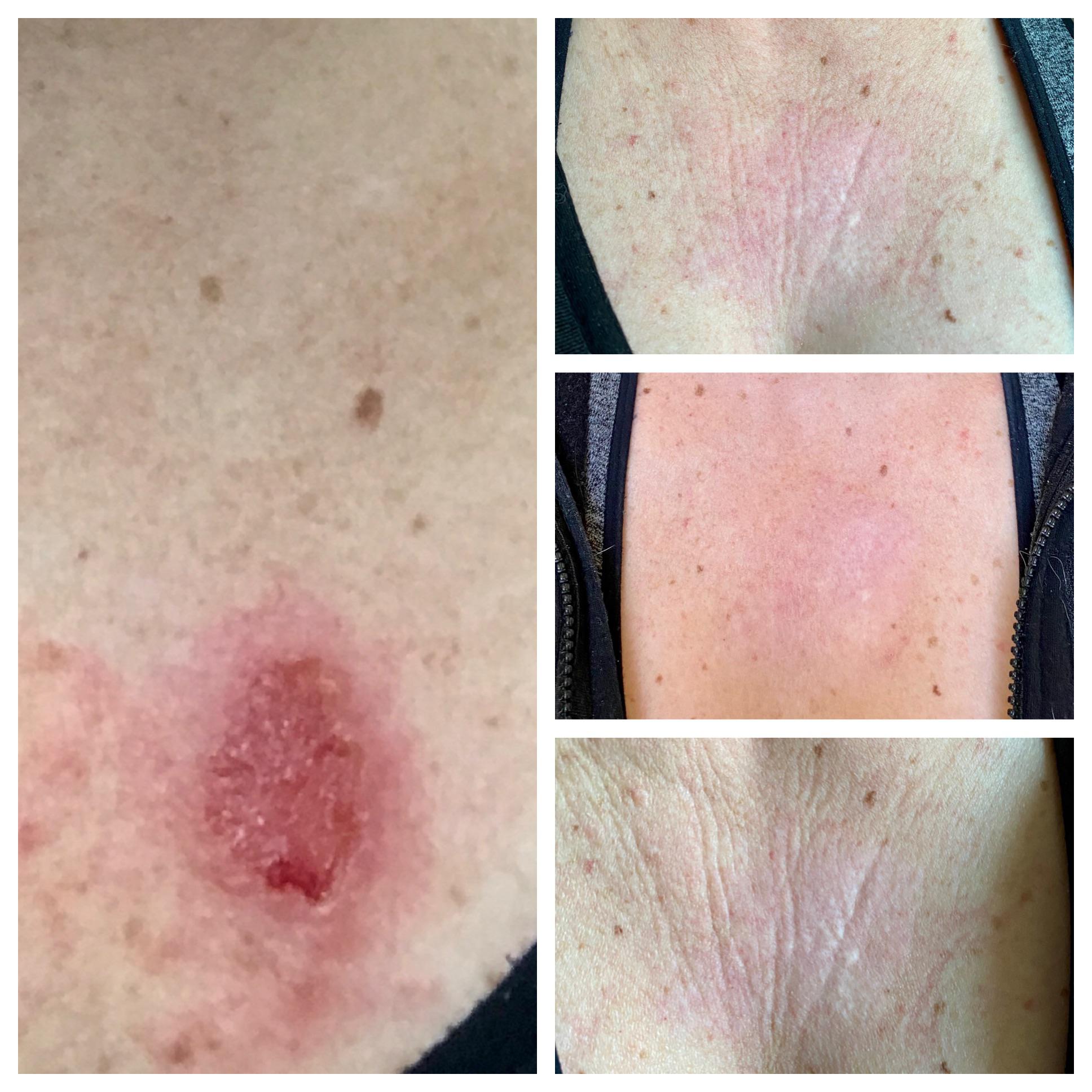 [PSA] Basal Cell Carcinomaor why you shouldn’t listen to r